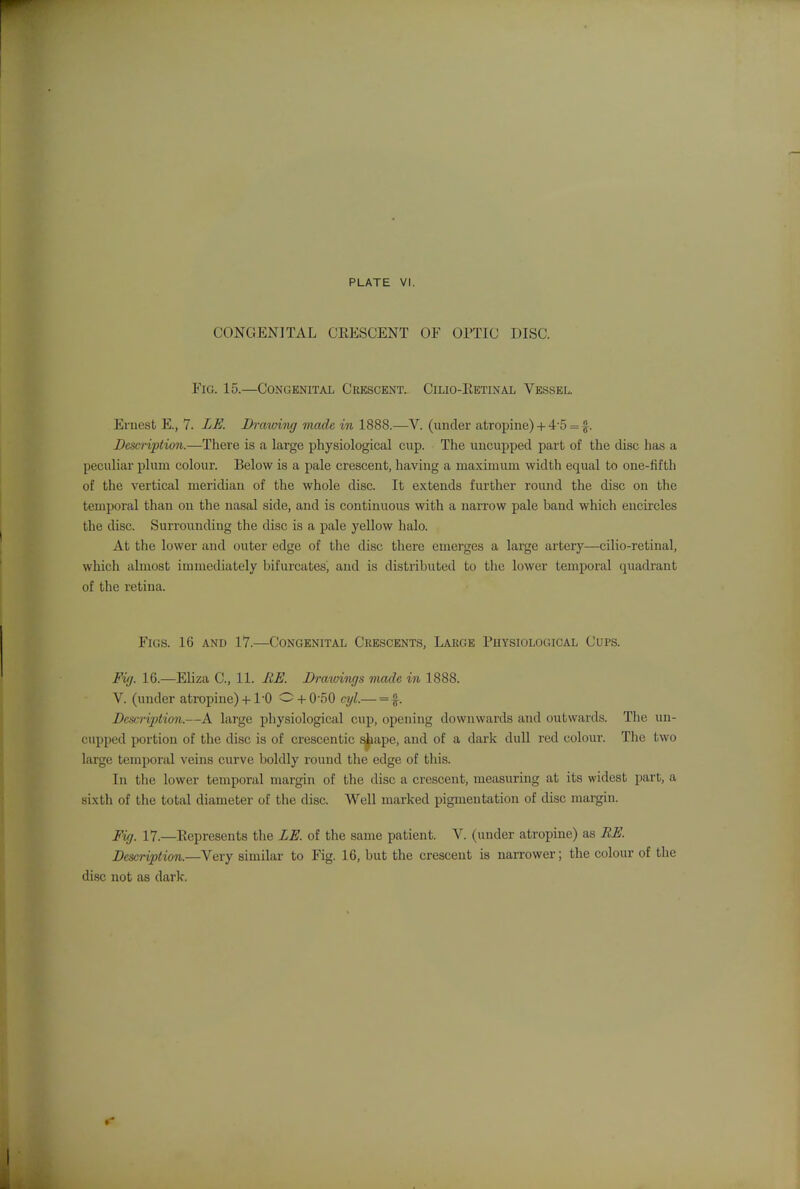 CONGENITAL CEESCENT OF OPTIC DISC. Fig. 15.—Congenital Crescent. Cilio-Eetinal Vessel. Ernest E., 7. LE. Drawing made in 1888.—V. (under atropine) + 4-5 = f. Description.—There is a large physiological cup. The uucupped part of the disc has a peculiar plum colour. Below is a pale crescent, having a maximum width equal to one-fifth of the vertical meridian of the whole disc. It extends further round the disc on the temporal than on the nasal side, and is continuous with a narrow pale band which encircles the disc. Surrounding the disc is a pale yellow halo. At the lower and outer edge of the disc there emerges a large artery—cilio-retinal, which almost immediately bifurcates, and is distributed to the lower temporal quadrant of the retina. Figs. 16 and 17.—Congenital Crescents, Large Physiological Cups. Fig. 16.—Eliza C, 11. HE. Drawings made in 1888. V. (under atropine)+ 1-0 0 + 0-50 cyl.— = f. Description.—A large physiological cup, opening downwards and outwards. The un- capped portion of the disc is of crescentic ^ape, and of a dark dull red colour. The two large temporal veins curve boldly round the edge of this. In the lower temporal margin of the disc a crescent, measuring at its widest part, a sixth of the total diameter of the disc. Well marked pigmentation of disc margin. Fig. 17.—Represents the LE. of the same patient. V. (under atropine) as RE. Description.—Very similar to Fig. 16, but the crescent is narrower; the colour of the disc not as dark.