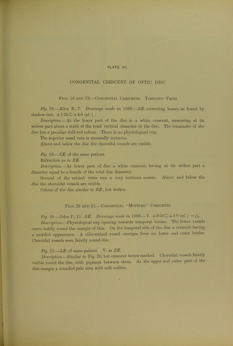 CONGENITAL CliESCENT OF OPTIC DISC. Figs. 18 and 19.—Congenital Cuescents. Toutuocs Veins. Fig. 18.—Alice B., 7. Drawings made in 1888.—HE. coiTecting lenses, as fouud by shadow-test, +1-50O + 4-0 cyl. \ . Desm-iption.—At the lower part of the disc is a white crescent, measuring at its widest part about a sixth of the total vertical diameter of the disc. The remainder of the disc has a peculiar dull-red colour. There is no physiological cup. The supei'ior nasal vein is unusually tortuous. Above and below the disc the choroidal vessels are visible. Fig. 19.—LE. of the same patient. Kefractioii as in RE. Dcsa-iption.—At lower part of disc a white crescent, having at its widest part a diameter equal to a fourth of the total disc diameter. Several of the retinal veins run a very tortuous course. Above and below the disc the choroidal vessels are visible. Colour of the disc similar to RE., but darker. Figs. 20 and 21.—Congenital Mottled Crescents. Fig. 20.—John P., 15. RE. Dmwiiujs made in 1888.—V. -f-0-50C-f 10 cijl. \ Dcicriidion.—Physiological cup opening towards temporal border. The lower vessels curve boldly round the margin of this. On the temporal side of tlie disc a crescent having a mottled appearance. A cilio-retinal vessel emerges from it.s lower and outer border. Choroidal vessels seen faintly round disc. Fig. 21.—LE. of same patient. V. as RE. Descriptor—Similar to Fig. 20, but crescent better marked. Choroidal vessels faintly visible round the disc, witli pigment between them. At the upper and outer part of tlie disc-margin a rounded pale area with soft outline.