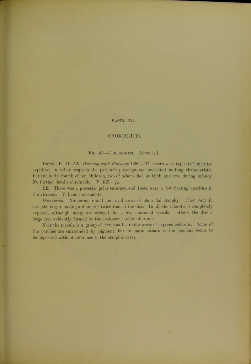 CHOROIDITIS. Fig. 42.—Chokoiditis. Advanced. Harriet E., 24. LE. Drawing made Feb'ruary 1890.—The teeth were t) pica! of inherited sypliilis; in other respects the patient's physiognomy presented nothing characteristic. Patient is the fourth of ten children, two of wlioiu died at birth, and two during infancy. No further details obtainable. V. RE. = ^% LE. There was a posterior polar cataract, and there were a few floating opacities in the vitreous. V. hand movements. Dcsci-i2}tion.—Numerous round and oval areas of choroidal atrophy. They vary in size, the larger having a diameter twice that of the disc. In all, the sclerotic is completely exposed, although many are crossed by a few choroidal vessels. Above the disc a large area evidently formed by the coalescence of smaller ones. Near the macula is a group of five small circular areas of exposed sclerotic. .Some of the patches are surrounded by pigment, but in most situations the pigment seems to be deposited without reference to the atrophic areas.