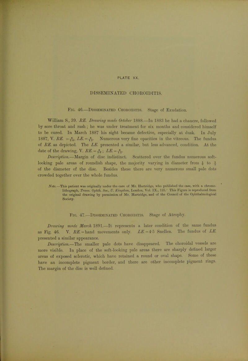 DISSEMINATED CHOEOIDITIS. Fig. 46.—Disseminated Choroiditis. Stage of Exudation. William S., 39. EE. Drmving made October 1888.—In 1883 he had a chauere, followed by sore throat and rash; he was under treatment for six months and considered himself to be cured. In March 1887 his sight became defective, especially at dusk. In July Y. BE. —-^,LE.=^^. Numerous very fine opacities in the vitreous. The fundus of RE. as depicted. The LE. presented a similar, but less advanced, condition. At the date of the drawing, V. BE. = ^j^; LE. = ^. Description.—Margin of disc indistinct. Scattered over the fundus numerous soft- looking pale areas of roundish shape, the majority varying in diameter from ^ to ^ of the diameter of the disc. Besides these there are very numerous small pale dots crowded together over the whole fundus. Note.—Thi.s patient was originally under the care of Mr. Hartridge, who published the case, with a chromo- lithograph, Trans. Opidh. Soc., V. Kingdom, London, Vol. IX., 125. This Figure is reproduced from the original drawing by permission of Mr. Hartridge, and of the Council of the Ophthalmological Society. Fig. 47.—Disseminated Choroiditis. Stage of Atrophy. Dra%oing made March 1891.—It represents a later condition of the same fundus as Fig. 46. V. BE. = \i?iXii\. movemeuts only. LE. = A-b Snellen. The fundus of LE. presented a similar appearance. Description.—The smaller pale dots have disappeared. The choroidal vessels are more visible. In place of the soft-looking pale areas there are sharply defined larger areas of exposed sclerotic, which have retained a round or oval shape. Some of these have an incomplete pigment border, and tliere are other incomplete pigment rings. The margin of the disc is well defined.