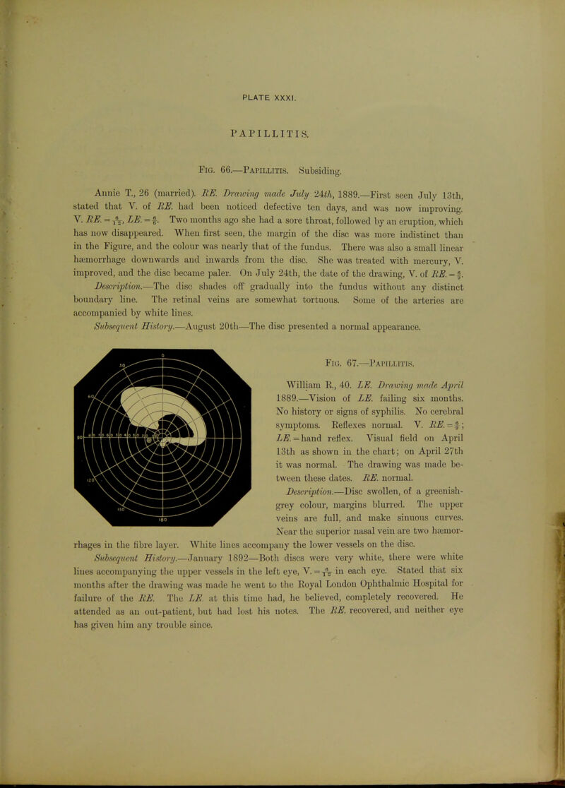 PAPILLITIS. Fig. 66.—Papillitis. Subsiding. Annie T., 26 (nianied). BE. Drawing viach My 24th, 1889.—First seen July 13th, stated that V. of EE. had been noticed defective ten days, and was now improving, v. EE. = LE. = f. Two months ago she had a sore throat, followed by an eruption, which has now disappeared. When first seen, the margin of the disc was more indistinct than in the Figure, and the colour was nearly that of the fundus. There was also a small linear hemorrhage downwards and inwards from the disc. She was treated with mercury, V. improved, and the disc became paler. On July 24th, the date of the drawing, V. of EE. = f. Besm-ipiion.—The disc shades off gradually into the fundus without any distinct boundary line. The retinal veins are somewhat tortuous. Some of the arteries are accompanied by white lines. Subsequent History.—August 20th—The disc presented a normal appearance. Fig. 67.—Papillitis. William E., 40. LE. Dmwiny made April 1889.—Vision of LE. failing six mouths. No history or signs of syphilis. No cerebral symptoms. Eefiexes normal. V. EE. = f; Z.ff. =hand reflex. Visual field on April 13th as shown in the chart; on April 27th it was normal. The drawing was made be- tween these dates. EE. normal. Description.—Disc swollen, of a greenish- grey colour, margins blurred. The upper veins are full, and make sinuous curves. Near the superior nasal vein are two hsemor- rhages in the fibre layer. White lines accompany the lower vessels on the disc. Subsequent Hi^ory.—January 1892—Both discs were very white, there were white lines accompanying the upper vessels in the left eye, V. =y«^ in each eye. Stated that sLx months after the drawing was made he went to the Royal London Ophthalmic Hospital for failure of the EE. The LE. at this time had, he believed, completely recovered. He attended as an out-patient, but had lost his notes. Tlie EE. recovered, and neither eye has given him any trouble since.