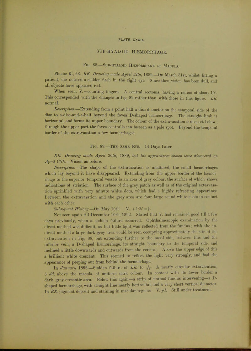 SUB-HYALOID HEMORRHAGE. Fig. 88.—Sub-hyaloid Haemorrhage at Macula. Phoebe K., 63. RE. Drmving made April 12th, 1889.—On March 31st, whilst hfting a patient, she noticed a sudden flash in the right eye. Since then vision has been dull, and all objects have appeared red. When seen, V. = counting fingers. A central scotoma, having a radius of about 10°. This corresponded with the changes in Fig. 89 rather than with those in this figure. LK normal. Description.—Extending from a point half a disc diameter on the temporal side of tlie disc to a-disc-and-a-half beyond the fovea D-shaped haemorrhage. The straight limb is horizontal, and forms its upper boundary. The colour of the extravasation is deepest below; through the upper part the fovea centralis can be seen as a pale spot. Beyond the temporal border of the extravasation a few haemorrhages. Fig. 89.—The Same Eye. 14 Days Later. BK Drawing made Api-il 2Qth, 1889, but the appearances shown were discovered on April 17th.—Vision as before. Description.—The shape of the extravasation is unaltered, the small haemorrhages which lay beyond it have disappeared. Extending from the upper border of the haemor- rhage to the superior temporal vessels is an area of grey colour, the surface of which shows indications of striatiou. The surface of the grey patch as well as of the original extravasa- tion sprinkled with very minute wliite dots, which had a liighly refracting appearance. Between the extravasation and the grey area are four large round white spots in contact with each other. Subsequent History.—On May 10th. V. +1'25 = §. Not seen again till December 10th, 1892. Stated that V. had remained good till a few days previously, when a sudden failure occurred. Ophthalmoscopic examination by the direct method was diflicult, as but little light was reflected from the fundus; with tiie in- direct method a large dark-grey area coidd be seen occupying approximately tlie site of the extravasation in Fig. 88, but extending further to the nasal side, between this and the inferior vein, a D-shaped haemorrhage, its straight boundary to tlie temporal side, and inclined a little downwards and outwards from tlie vertical. Above the upper edge of this a brilliant white crescent. This seemed to reflect the light very strongly, and had the appearance of peeping out from behind the htemorrhage. In January 1896.—Sudden failure of LK to VV- ^ e^irly circular extravasation, 3 dd. above the macula, of uniform dark colour. In contact with its lower liorder a dark grey cresentic area. Below this again—a strip of normal fundus intervening-a D- shaped hemorrhage, with straight line nearly horizontal, and a very short vertical diameter.