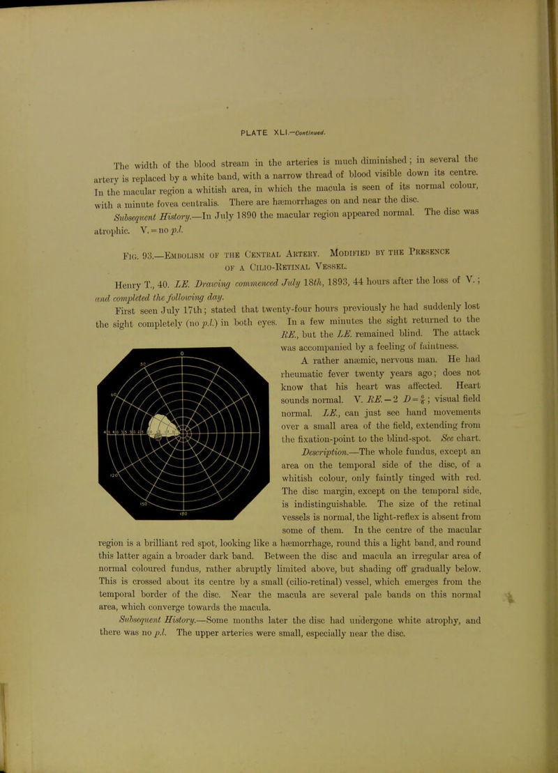 The width of the blood stream in the arteries is much diminished ; in several the artery is replaced by a white band, with a narrow thread of blood visible down its centre. In the macular region a whitish area, in whicli the macula is seen of its normal colour, with a minute fovea centralis. Tliere are ha;morrhages on and near the disc. Subsequent History.—In July 1890 the macular region appeared normal. The disc was atrophic. V. = no p.l. Fig. 93.—Embolism of the Centhal Akteky. Modikied by the Presence OK A ClLlO-IlETIXAL VESSEL. Henry T., 40. LK Drawing commenced July 18th, 1893, 44 hours after the loss of V.; and completed the folhwing day. First seen July 17th; stated that twenty-four hours previously he had suddenly lost the siglit completely (no p.l.) in both eyes. In a few minutes the sight returned to the MJi!., but the LK remained blind. The atUick WHS accompanied by a feeling of faintness. A rather anaemic, nervous man. He had rheumatic fever twenty years ago; does not know that his heart was affected. Heart sounds nomal. V. BK-2 D = i; visual field normal. LE., can just see hand movements over a small area of the field, extending from the fixation-point to the blind-spot. Sec chart. Description.—The whole fundus, except an area on the temporal side of the disc, of a whitish colour, only faintly tinged with red. The disc margin, except on the tetnporal side, is indistinguishable. The size of the retinal vessels is normal, the light-reflex is absent from some of them. In the centre of the macular region is a brilHant red spot, looking Uke a luemorrhage, round this a light band, and round this latter again a broader dark band. Between the disc and macula an irregular area of normal coloured fundus, rather abruptly limited above, but shading off gradually below. This is crossed about its centre by a small (cilio-retinal) vessel, which emerges from the temporal border of the disc. Near the macula are several pale bands on this noininl area, which converge towards the macula. Svhseqtient History.—Some months later the disc had inidergone white atrophy, and there was no p.l. The upper arteries were small, especially near the disc.