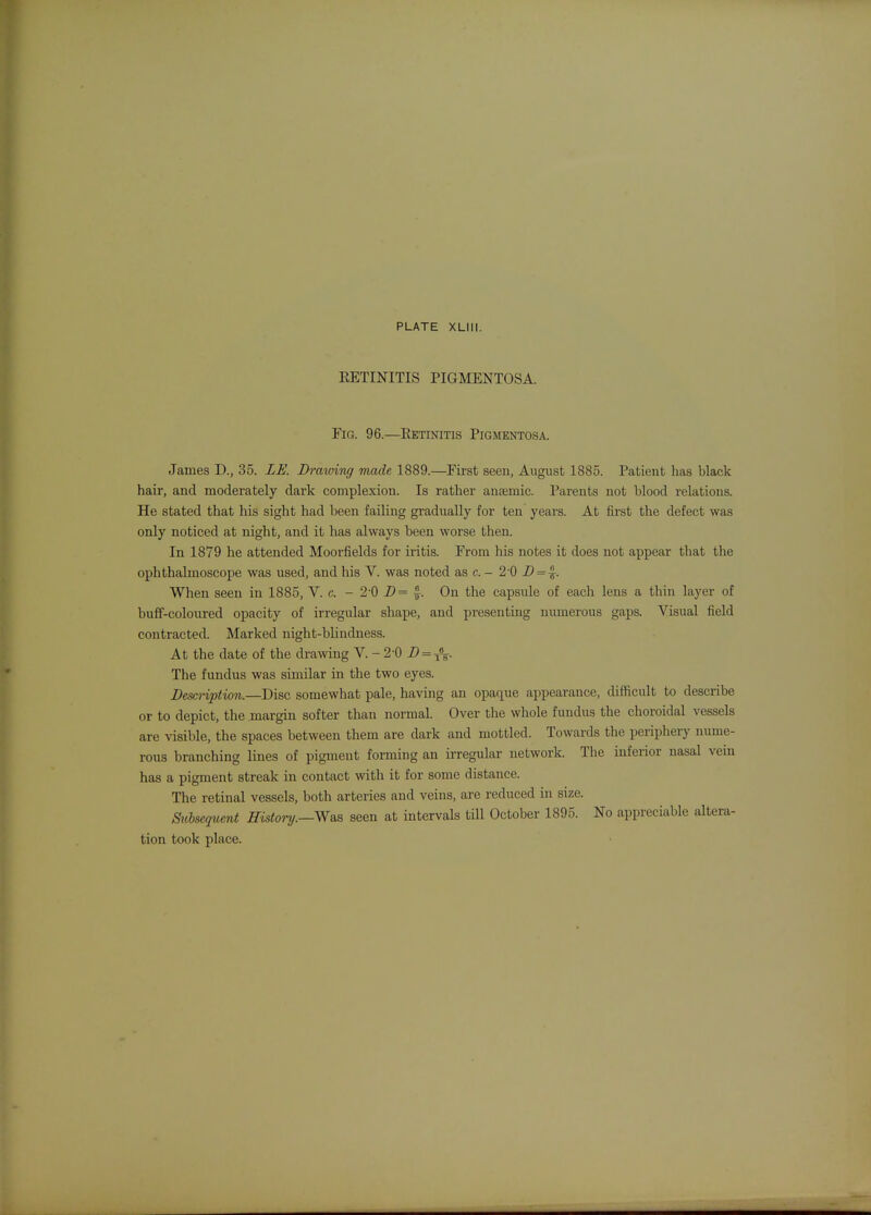 EETINITIS PIGMENTOSA. Fig. 96.—Eetinitis Pigmentosa. James D., 35. LE. Drawivg made 1889.—First seen, August 1885. Patient has black hair, and moderately dark complexion. Is rather anaemic. Parents not blood relations. He stated that his sight had been failing gradually for ten years. At first the defect was only noticed at night, and it has always been worse then. In 1879 he attended Moorfields for iritis. From his notes it does not appear that the ophthalmoscope was used, and his V. was noted as c. - 2'0 X' = |. When seen in 1885, V. c. - 2 0 D= ^. On the capsule of each lens a thin layer of buff-coloured opacity of irregular shape, and presenting numerous gaps. Visual field contracted. Marked night-blindness. At the date of the drawing V. - 2-0 D = ^. The fundus was similar in the two eyes. Descnption.—Disc somewhat pale, having an opaque appearance, difficult to describe or to depict, the margin softer than normal. Over the whole fundus the choroidal vessels are visible, the spaces between them are dark and mottled. Towards the periphery nume- rous branching lines of pigment forming an irregular network. The inferior nasal vein has a pigment streak in contact with it for some distance. The retinal vessels, both arteries and veins, are reduced in size. Suise([uent History.—Ws.^ seen at intervals till October 1895. No appreciable altera- tion took place.