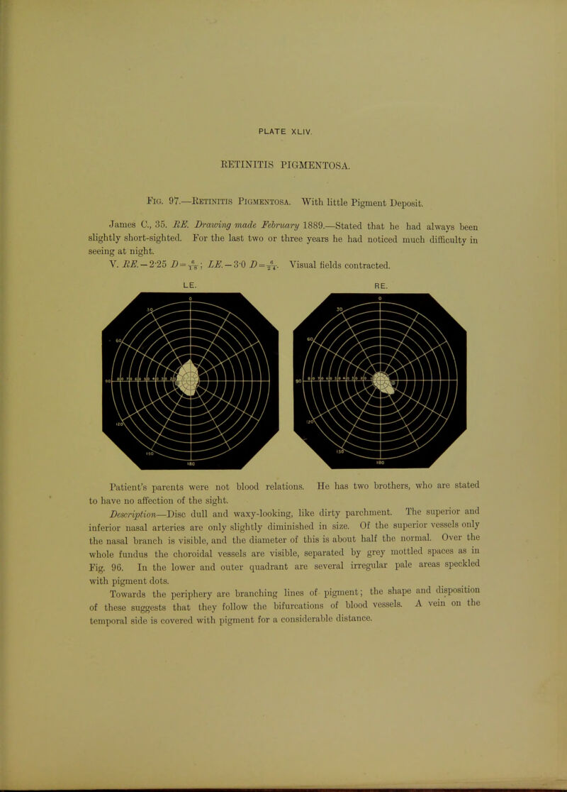 EETINITIS PIGMENTOSA. EiG. 97.—EETINITIS Pigmentosa. With little Pigment Deposit. James 0., 35. RE. Drawing made Febmary 1889.—Stated that he had always been slightly short-sighted. For the last two or three years he had noticed much difficulty in seeing at night. V. ItE.-2-2o D = ^; LE.-3 0 = Visual fields contracted. LE. RE. Patient's parents were not blood relations. He has two brothers, who are stated to have no affection of the sight. Description—Disc dull and waxy-looking, like dirty parchment. Tlie superior and inferior nasal arteries are only slightly diminished in size. Of the superior vessels only the nasal branch is visible, and tlie diameter of this is about half the normal. Over the whole fundus the choroidal vessels are visible, separated by grey mottled spaces as in Fig. 96. In the lower and outer quadrant are several irregular pale areas speckled with pigment dots. Towards the periphery are brandling lines of pigment; the sliape and disposition of these suggests that they follow the bifurcations of blood vessels. A vein on the temporal side is covered with pigment for a considerable distance.