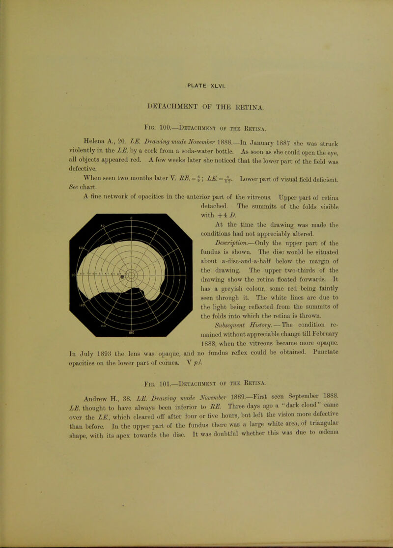 DETACHMENT OF THE RETINA. Fig. 100.—Detachment ok the Retina. Heleua A., 20. LE. Drawing made November 1888.—In January 1887 she was struck violently in the LE. by a cork from a soda-water bottle. As soon as she could open the eye, all objects appeared red. A few weeks later she noticed that the lower part of the field was defective. When seen two months later V. HE. -1.; LE. = ^. Lower part of visual field deficient. See chart. A fine network of opacities in the anterior part of the vitreous. Upper part of retina detached. Tlie summits of the folds visible with +4 Z*. At the time the drawing was made the conditions had not appreciably altered. Description.—Only the upper part of the fimdus is shown. The disc would be situated about a-disc-and-a-half below the margin of the drawing. The upper two-thirds of the drawing show the retina floated forwards. It lias a greyish colour, some red being faintly seen through it. The white lines are due to the light being reflected from the summits of the folds into which the retina is thrown. Subsequent History. — The condition re- mained without appreciable change till February 1888, when the vitreous became more opaque. In Jidy 1893 the lens was opaque, and no fundus reflex could be obtained. Punctate opacities on the lower part of cornea. V p.l. Fig. 101.—Detachment of the Retina. Andrew H., 38. LE. Drawing made November 1889.—First seen September 1888. LE. thought to have always been inferior to BE Three days ago a dark cloud came over the LE, which cleared off after four or five hours, but left tlie vision more defective than before. In the upper part of the fundus there was a large white area, of triangular shape, with its apex towards the disc. It was doubtful wiiether this was due to oedema