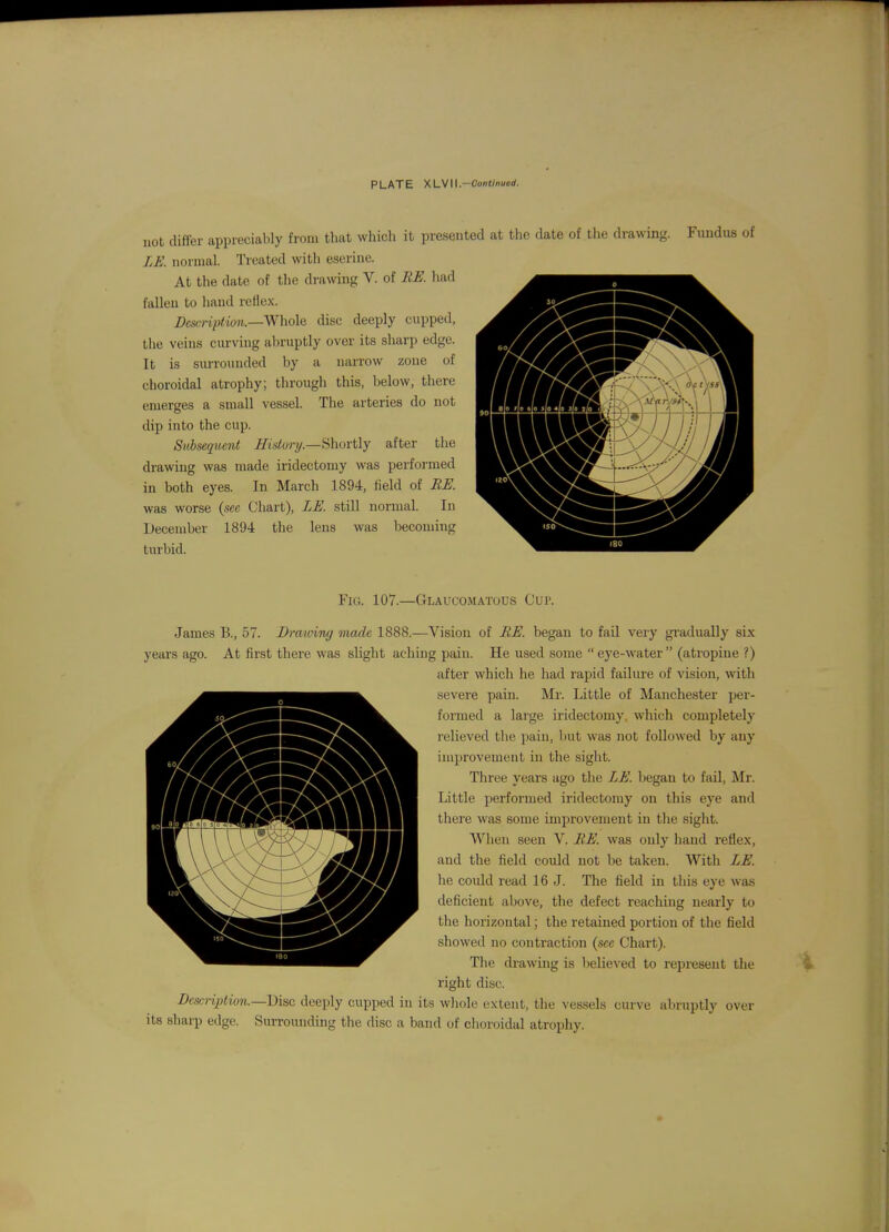 PLATE XL^W.-Continued. not differ appreciably from that which it presented at the date of the drawing. Fundus of LK normal. Treated with eserine. At the date of the drawing V. of BK liad fallen to hand reflex. description.—Whol(i disc deeply cupped, the veins curving abruptly over its sharp edge. It is surrounded by a narrow zone of choroidal atrophy; through this, below, there emerges a small vessel. The arteries do not dip into the cup. Subsequent Histury.—Shortly after the drawing was made iridectomy was performed in both eyes. In March 1894, Held of BE. was worse {see Chart), LE. still normal. In December 1894 the lens was becoming turbid. Fig. 107.—Glaucomatuus Cup. James B., 57. Drawing made 1888.—Vision of BE. began to fail very gradually six years ago. At first there was slight aching pain. He used some eye-water (atropine ?) after which he had rapid failure of vision, with severe pain. Mr. Little of Manchester per- formed a large iridectomy, which completely relieved the ])aiu, but was not follow^ed by any improvement in the sight. Three years ago the LE. began to fail, Mr. Little performed iridectomy on this eye and there was some improvement in the sight. When seen V. BE. was only hand reflex, and the field could not be taken. With LE. he coidd read 16 J. The field in this eye was deficient above, the defect reaching nearly to the horizontal; the retained portion of the field showed no contraction {sec Chart). The drawing is believed to repi-eseut the right disc. Description.—V)im deeply cupped in its whole extent, the vessels curve aljruptly over its sharp edge. Surroundmg the disc a band of choroidal atrophy.