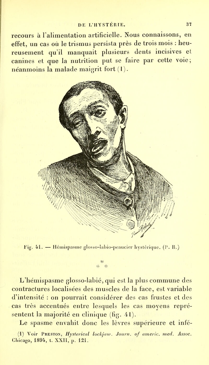 recours à l'alimentation artificielle. Nous connaissons, en effet, un cas où le trismus persista près de trois mois : heu- reusement qu'il manquait plusieurs dents incisives et canines et que la nutrition put se faire par cette voie; néanmoins la malade maigrit fort (l). Fig. 41. — Hémispasme glosso-labio-peaucier hystérique. (I'. R.) L'hémispasme glosso-labié, qui est la plus commune des contractures localisées des muscles de la face, est variable d'intensité : on pourrait considérer des cas frustes et des cas très accentués entre lesquels les cas moyens repré- sentent la majorité en clinique (fig. 41). Le spasme envahit donc les lèvres supérieure et infé- (1) Voir Preston, Hyslerical lockjaw. Journ. of americ. med. Assoc. Chicago, 1894, t. XXII, p. 121.