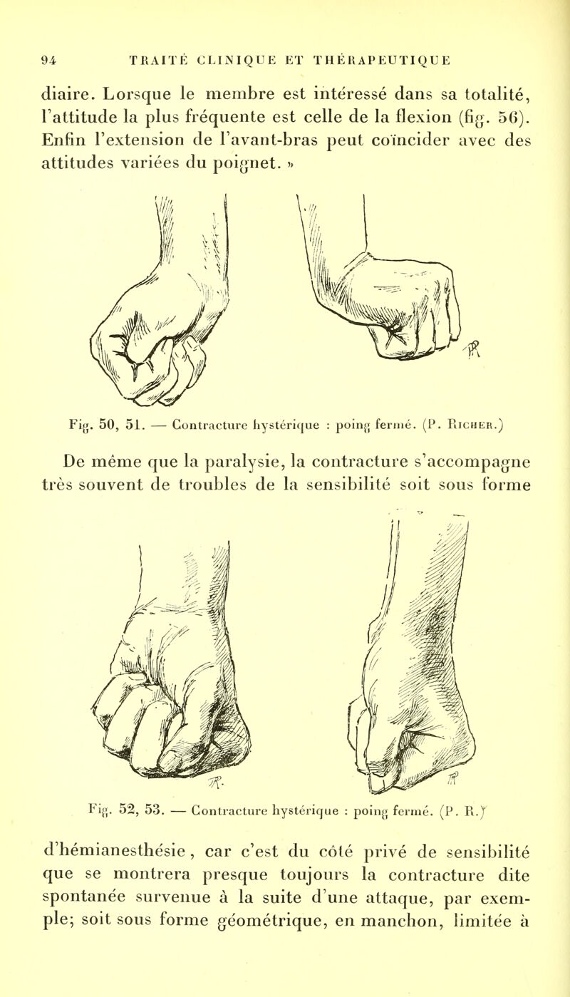 diaire. Lorsque le membre est intéressé dans sa totalité, l'attitude la plus fréquente est celle de la flexion (fig. 56). Enfin l'extension de l avant-bras peut coïncider avec des attitudes variées du poignet. » Fig. 50, 51. — Contracture hystérique : poing fermé. (P. PiiCHER.) De même que la paralysie, la contracture s'accompagne très souvent de troubles de la sensibilité soit sous forme Fig. 52, 53. — Contracture hystérique : poing fermé. (P. Pi.J d'hémianesthésie , car c'est du côté privé de sensibilité que se montrera presque toujours la contracture dite spontanée survenue à la suite d'une attaque, par exem- ple; soit sous forme géométrique, en manchon, limitée à