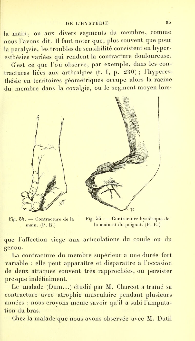 la main, ou aux divers segments du membre, comme nous l'avons dit. Il faut noter que, plus souvent que pour la paralysie, les troubles de sensibilité consistent en hyper- esthésies variées qui rendent la contracture douloureuse. C'est ce que l'on observe, par exemple, dans les con- tractures liées aux arthralgies (t. I, p. 230) ; l'hyperes- thésie en territoires géométriques occupe alors la racine du membre dans la coxalgie, ou le segment moyen lors- Fig. 54. — Contracture de la Fiy. 55. — Contracture hystérique de main. (F. R.) la main et du poignet. (P. R.) que l'affection siège aux articulations du coude ou du genou. La contracture du membre supérieur a une durée fort variable : elle peut apparaître et disparaître à l'occasion de deux attaques souvent très rapprochées, ou persister presque indéfiniment. Le malade (Dum...) étudié par M. Gliarcot a traîné sa contracture avec atrophie musculaire pendant plusieurs années : nous croyons même savoir qu'il a subi l'amputa- tion du bras. Chez la malade que nous avons observée avec M. Dutil