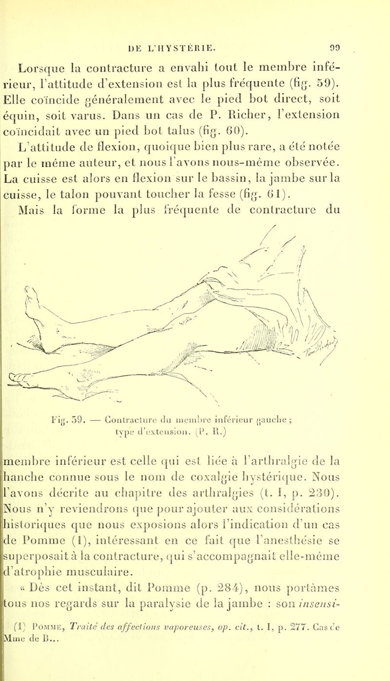 Lorsque la contracture a envahi tout le membre infé- rieur, l'attitude d'extension est la plus fréquente (%. 59). Elle coïncide généralement avec le pied bot direct, soit équin, soit varus. Dans un cas de P. Richer, l'extension coïncidait avec un pied bot talus (fig. 60). L'attitude de flexion, quoique bien plus rare, a été notée par le même auteur, et nous l'avons nous-mêmc observée. La cuisse est alors en flexion sur le bassin, la jambe sur la cuisse, le talon pouvant toucher la fesse (fig. (il). Mais la forme la plus fréquente de contracture du Fig. 53. — Contracture du membre inférieur gauche ; type d'extension. (P. 11.) membre inférieur est celle qui est liée à l'arthralgie de la hanche connue sous le nom de coxalgie hystérique. Nous l'avons décrite au chapitre des arthralgies (t. 1, p. 230). Nous n'y reviendrons que pour ajouter aux considérations historiques que nous exposions alors l'indication d'un cas de Pomme (I), intéressant en ce fait que l'anesthésie se superposait à la contracture, qui s'accompagnait elle-même d'atrophie musculaire. « Dès cet instant, dit Pomme (p. 284), nous portâmes tous nos regards sur la paralysie de la jambe : son insensi- (ï) Pomme, Traité des affections vaporeuses, op. cit., t. I, p. 277. Cas ce Mme de 13...