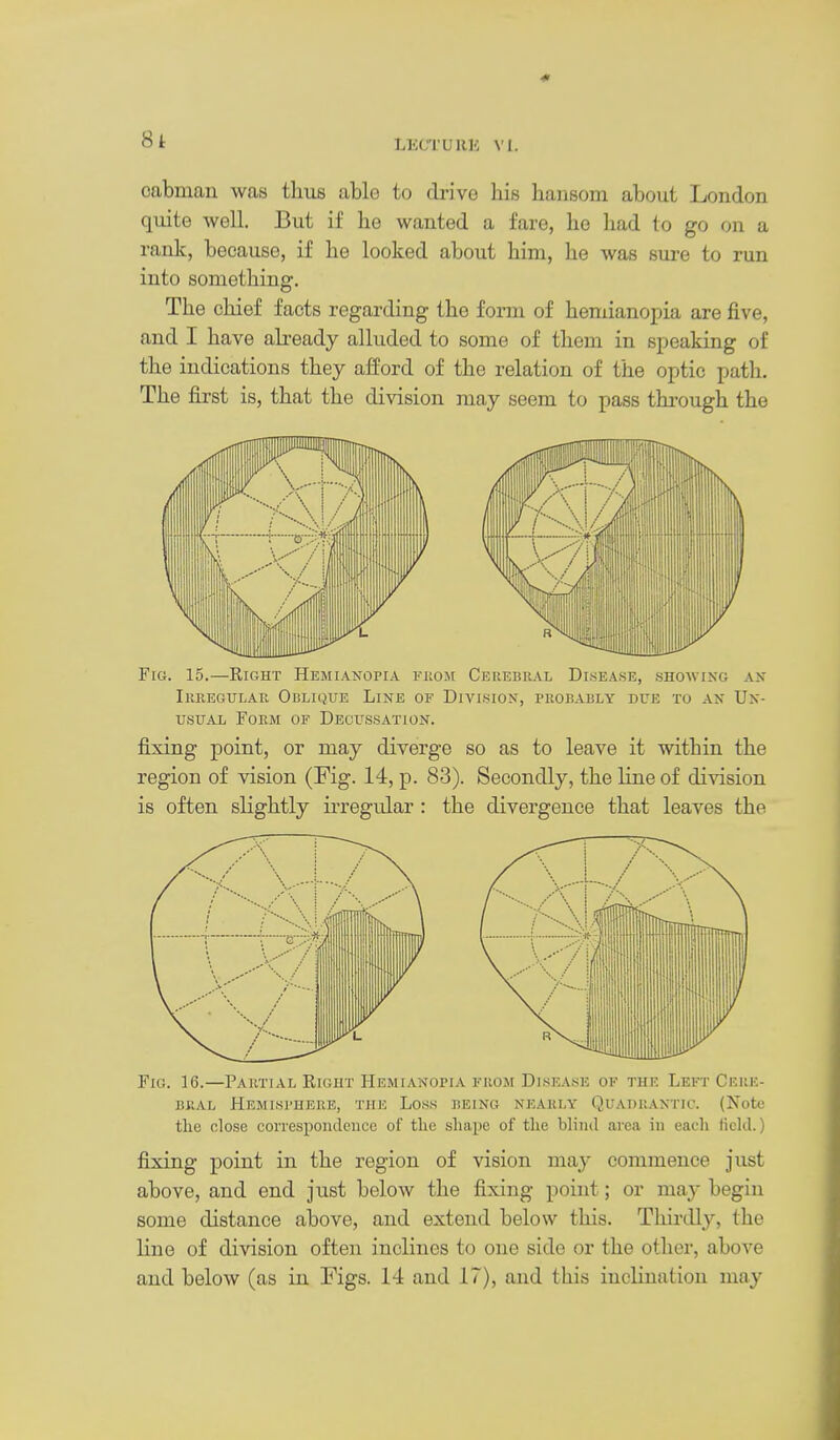 8t cabman was thus able to drive his hansom about London quite well. But if he wanted a fare, he had to go on a rank, because, if he looked about him, he was sure to run into something. The chief facts regarding the form of hemianopia are five, and I have abeady alluded to some of them in siieaking of the indications they afford of the relation of the optic path. The first is, that the division may seem to pass through the Fig. 15.—Right Hemianopia fiiom Cerebral Disease, showing an Ikregulau Oblique Line of Division, probably due to an Un- usual Form of Decussation. fixing point, or may diverge so as to leave it within the region of vision (Fig. 14, p. 83). Secondly, the line of division is often slightly irregular : the divergence that leaves the Fig. 16.—Partial Right Hemianopia from Disease of thf. Left Cere- bral Hemisphere, the Loss being nearly Quadrantic. (Note the olose conespondeiice of tlic shape of the blind area in eacli field.) fixing point in the region of vision may commence just above, and end just below the fixing point; or may begin some distance above, and extend below this. Thirdly, the line of division often inclines to one side or the other, above and below (as in Figs. 14 and 17), and this inclination may