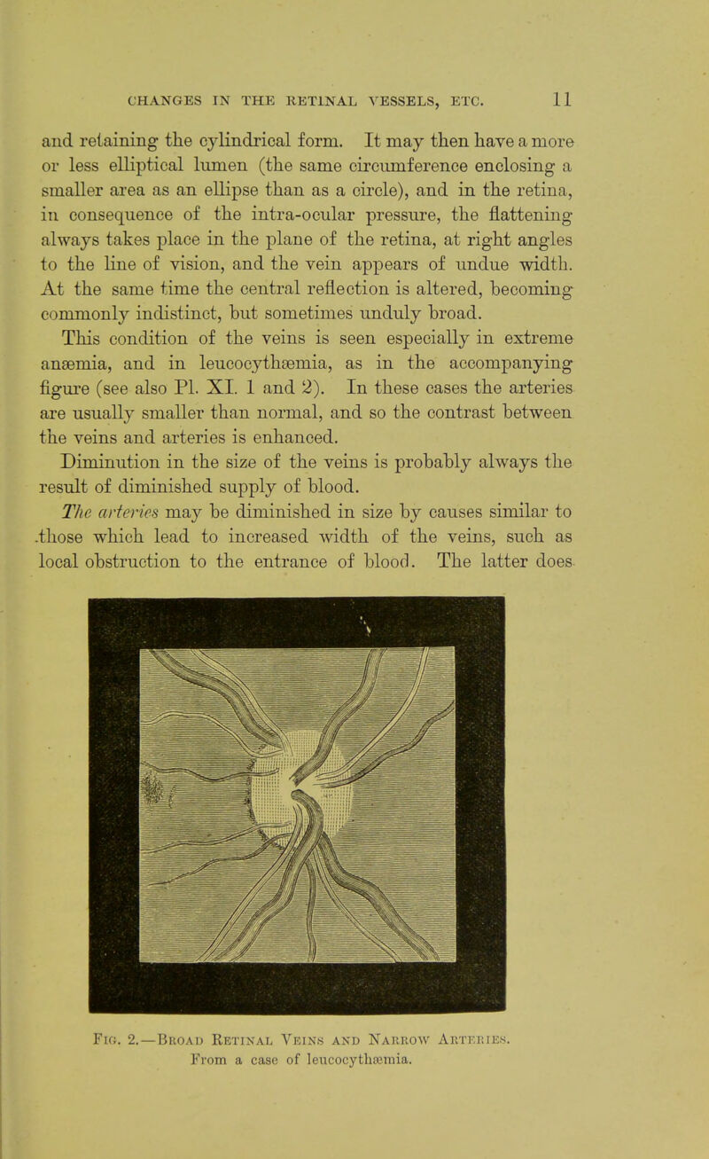 and retaining the cylindrical form. It may then have a more or less elliptical lumen (the same circumference enclosing a smaller area as an ellipse than as a circle), and in the retina, in consequence of the intra-ocular pressure, the flattening always takes place in the plane of the retina, at right angles to the line of vision, and the vein appears of undue width. At the same time the central reflection is altered, becoming commonly indistinct, but sometimes unduly broad. This condition of the veins is seen especially in extreme anaemia, and in leucocythaemia, as in the accompanying figui'e (see also PI. XI. 1 and 2). In these cases the arteries are usually smaller than normal, and so the contrast between the veins and arteries is enhanced. Diminution in the size of the veins is probably always the result of diminished supply of blood. The arteries may be diminished in size by causes similar to -those which lead to increased width of the veins, such as local obstruction to the entrance of blood. The latter does- Fir;. 2.—Begad Retinal Veins and Naiirow Aeteeies. From a case of leucocytlisemia.