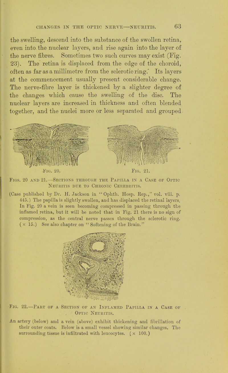 the swelling, descend into the substance of the swollen retina, even into the nuclear layers^ and rise again into the layer of the nerve fibres. Sometimes two such curves may exist (Fig. 23). The retina is displaced from the edge of the choroid, often as far as a millimetre from the sclerotic ring.' Its layers at the commencement usually present considerable change. The nerve-fibre layer is thickened by a slighter degree of the changes which cause the swelling of the disc. The nuclear layers are increased in thickness and often blended together, and the nuclei more or less separated and grouped Fio. 22.—Paut of a Section of an Inflamed Papilla in a Case of Optic Neuiutis. An artery (below) ami a vein (above) exhibit thickening and fibrillation of their outer coats. Below is a small vessel showing similar changes. The surrounding tissue is infiltrated with leucocytes. ( x 100.) Figs. 20 and 21.—Sections through the Papilla in a Case of Optic Neuritis due to Chronic Cerebritis. (Case published by Dr. H. Jackson in “ Ophth. Ho.sp. Rep.,” vol. viii. p. 445.) The papilla is slightly swollen, and has displaced the retinal layers. In Fig. 20 a vein is seen becoming compressed in passing through the inflamed retina, but it will be noted that in Fig. 21 there is no sign of compression, as the central nerve passes through the sclerotic ring. ( X 15.) See also chapter on “ Softening of the Brain.” •Fig. 20. Fig. 21.