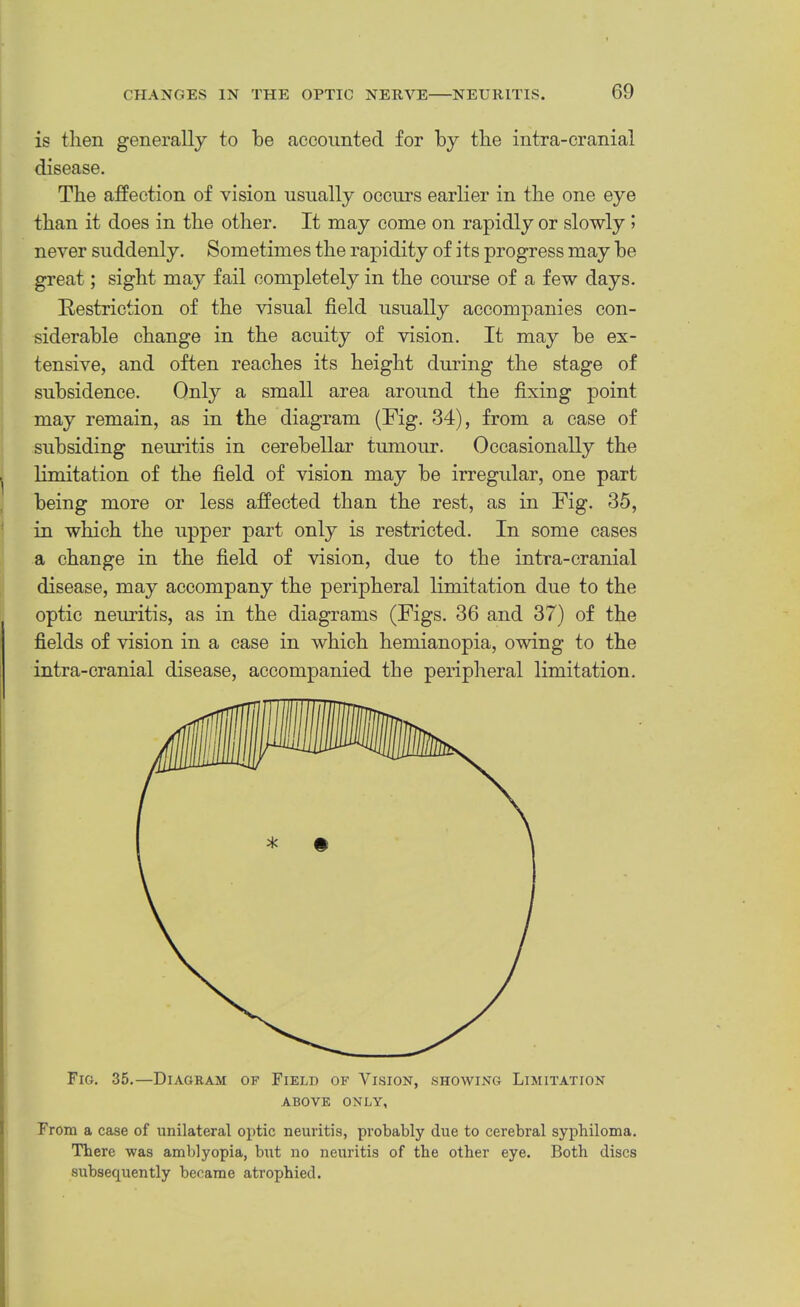 is then generally to be accounted for by the intra-cranial disease. The affection of vision usually occurs earlier in the one eye than it does in the other. It may come on rapidly or slowly I never suddenly. Sometimes the rapidity of its progress may be great; sight may fail completely in the course of a few days. Kestriction of the visual field usually accompanies con- siderable change in the acuity of vision. It may be ex- tensive, and often reaches its height during the stage of subsidence. Only a small area around the fixing point may remain, as in the diagram (Fig. 34), from a case of subsiding neuritis in cerebellar tumour. Occasionally the limitation of the field of vision may be irregular, one part being more or less affected than the rest, as in Fig. 35, in which the upper part only is restricted. In some cases a change in the field of vision, due to the intra-cranial disease, may accompany the peripheral limitation due to the optic nemitis, as in the diagrams (Figs. 36 and 37) of the fields of vision in a case in which hemianopia, owing to the intra-cranial disease, accompanied the peripheral limitation. Fig. 35.—Diagram of Field of Vision, showing Limitation ABOVE ONLY, From a case of unilateral optic neuritis, probably due to cerebral syphiloma. There was amblyopia, but no neuritis of the other eye. Both discs subsequently became atrophied.