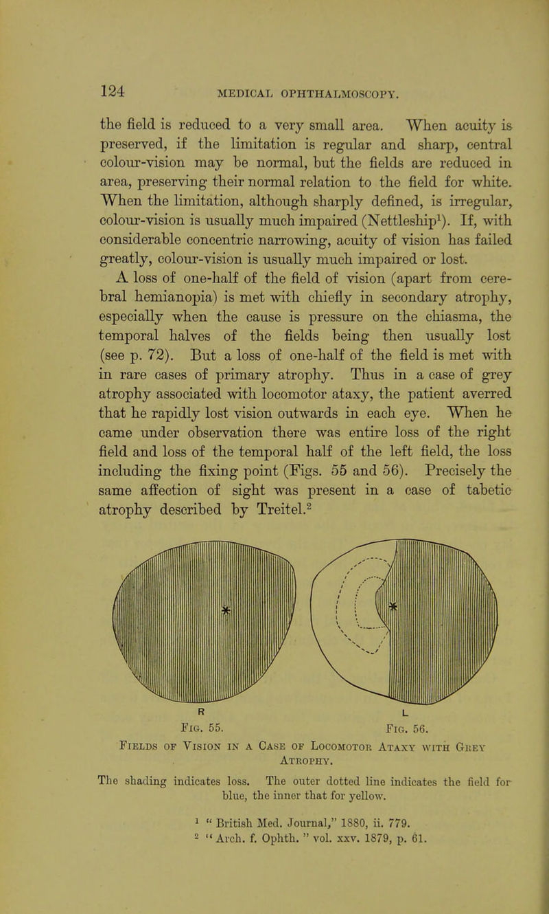 the field is reduced to a very small area. When acuity is preserved, if the limitation is regular and sharp, central colour-vision may he normal, but the fields are reduced in area, preserving their normal relation to the field for white. When the limitation, although sharply defined, is irregular, colour-vision is usually much impaired (Nettleship^). If, with considerable concentric narrowing, acuity of vision has failed greatly, colour-vision is usually much impaired or lost. A loss of one-half of the field of vision (apart from cere- bral hemianopia) is met with chiefiy in secondary atrophy, especially when the cause is pressure on the chiasma, the temporal halves of the fields being then usually lost (see p. 72). But a loss of one-half of the field is met with in rare cases of primary atrophy. Thus in a case of grey atrophy associated with locomotor ataxy, the patient averred that he rapidly lost vision outwards in each eye. When he came under observation there was entire loss of the right field and loss of the temporal half of the left field, the loss including the fixing point (Figs. 55 and 56). Precisely the same affection of sight was present in a case of tabetic atrophy described by Treitel.^ Fields of Vision in a Case of Locomotor Ataxy with Grey Atrophy. The shading indicates loss. The outer dotted line indicates the field for blue, the inner that for yellow. ^ “ British Med. Journal,” 1880, ii. 779. - “Arch. f. Ophth. ” vol. xxv. 1879, p. 61.