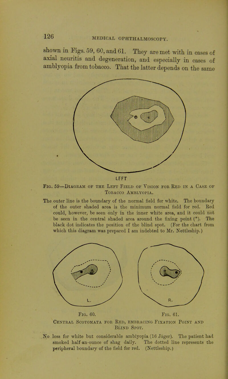 MEDICAL OPHTHALMOSCOPY, shown in Figs. 59, 60, and 61. They are met with in cases of axial neuritis and degeneration, and especially in cases of amblyopia from tobacco. That the latter depends on the same Fig. 59—Diagram of the Left Field of Vision for Red in a Case of Tobacco Amblyopia. The outer line is the boundary of the normal field for white. The boundary of the outer shaded area is the minimum normal field for red. Red could, however, be seen only in the inner white area, and it could not be seen in the central shaded area around the fixing point (*). The black dot indicates the position of the blind spot. (For the chart from which this diagram was prepared I am indebted to Mr. Nettleship.) Fig. 60. Fig. 61. Central Scotomata for Red, embracing Fixation Point and Blind Spot, No loss for white but considerable amblyopia (16 Jiiger). The patient had smoked half an-ounce of shag daily. The dotted line represents the peripheral boundary of the field for red. (Nettleship.)