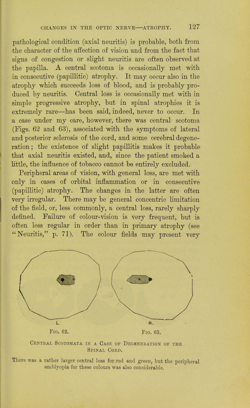 pathological condition (axial neuritis) is probable, both from the character of the affection of vision and from the fact that signs of congestion or slight neuritis are often observed at the papilla. A central scotoma is occasionally met with in consecutive (papillitic) atrophy. It may occur also in the atrophy which succeeds loss of blood, and is probably pro- duced by neuritis. Central loss is occasionally met with in simple progressive atrophy, but in spinal atrophies it is extremely rare—has been said, indeed, never to occur. In a case under my care, however, there was central scotoma (Figs. 62 and 63), associated with the symptoms of lateral and posterior sclerosis of the cord, and some cerebral degene- ration ; the existence of slight papillitis makes it probable ^ that axial neuritis existed, and, since the patient smoked a ' little, the influence of tobacco cannot be entirely excluded. Peripheral areas of vision, with general loss, are met -with only in cases of orbital inflammation or in consecutive (papillitic) atrophy. The changes in the latter are often very irregular. There may be general concentric limitation of the fleld, or, less commonly, a central loss, rarely sharply deflned. Failure of colour-vision is very frequent, but is often less regular in order than in primary atrophy (see “Neuritis,” p. 71). The colour flelds may present very Fig. 62. Fig. 63. Centkal Scotomata in a Case of Degeneration of the Spinal Cord. There was a rather larger central loss for red and gi’een, but the peripheral amblyopia for these colours was also considerable.