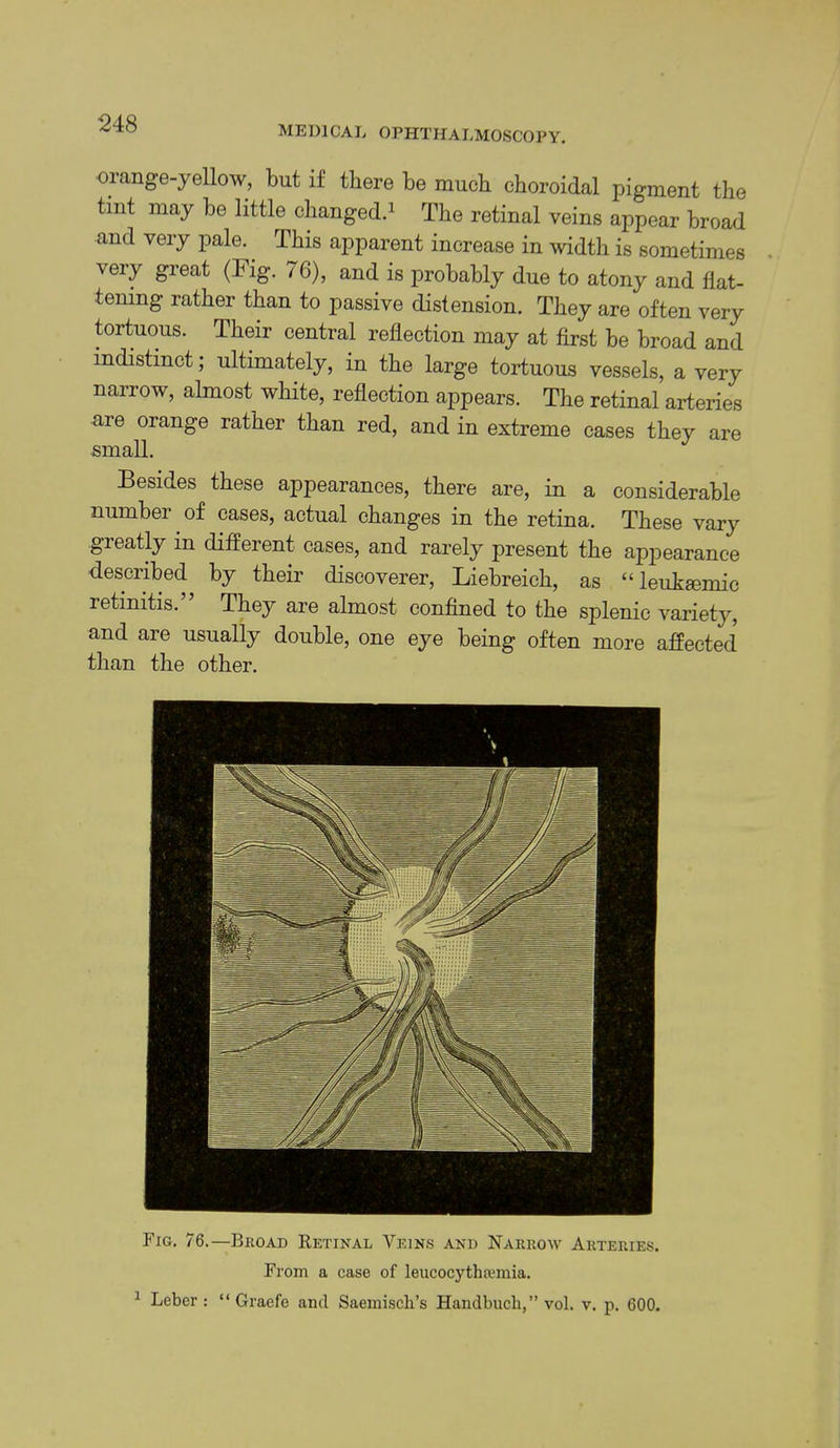 MEDICAL OPHTHALMOSCOPY. 01 ange-yellow, but if there be much choroidal pigment the tint may be little changed.^ The retinal veins appear broad and very pale. ^ This apparent increase in width is sometimes very great (Fig. 76), and is probably due to atony and flat- tening rather than to passive distension. They are often very tortuous. Their central reflection may at first be broad and indistinct; ultimately, in the large tortuous vessels, a very narrow, almost white, reflection appears. The retinal arteries are orange rather than red, and in extreme cases they are small. Besides these appearances, there are, in a considerable number of cases, actual changes in the retina. These vary greatly in different cases, and rarely present the appearance described by their discoverer, Liebreich, as “leukemic retinitis.” They are almost confined to the splenic variety, and are usually double, one eye being often more affected than the other. Fig. 76.—Begad Ketinal Veins and Narrow Arteries. From a case of leucocytha>mia. ^ Leber: “ Graefe ami Saemiscli’s Handbucli,” vol. v. p. 600.