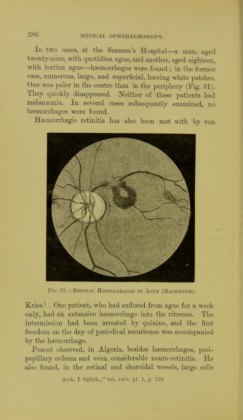 28G Ill two cases, at the Seamen’s Hospital—a man, aged twenty-nine, with quotidian ague, and another, aged eighteen, with tertian ague—hiemorrhages were found ; in the former case, numerous, large, and superficial, leaving white patches. One was paler in the centre than in the periphery (Ifig. 81). They quickly disappeared. Neither of these patients had melansemia. In several cases subsequently examined, no hsemorrhages were found. Haemorrhagic retinitis has also been met with by von Fig. 81.—Retinal Hemorrhages in Ague (Mackenzie). Kries.^ One patient, who had suffered from ague for a week only, had an extensive haemorrhage into the vitreous. The intermission had been arrested by quinine, and the first freedom on the day of periodical recm’rence was accompanied by the haemorrhage. Poncet observed, in Algeria, besides haemorrhages, peri- papillary oedema and even considerable neuro-retinitis. He also found, in the retinal and choroidal vessels, large cells Arch. f. Ophth.,” vol. xxiv. pt. 1, p. 159.