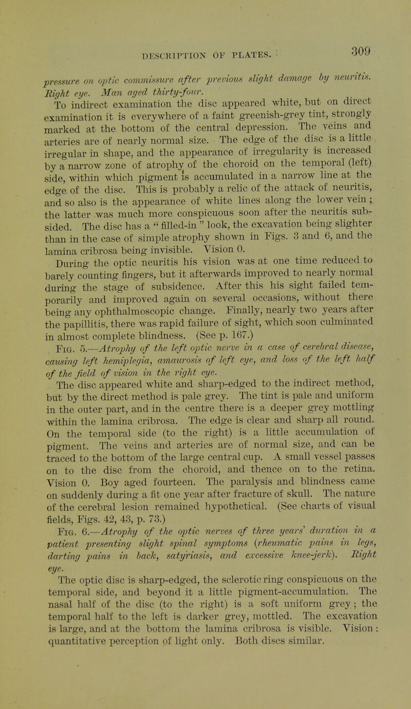 pressure on optic commissure after 2rrevious slight damage by neuritis. Right eye. Man aged thirty-four. To indirect examination the disc appeared white, but on direct examination it is everywhere of a faint greenish-grey tint, strongly marked at the bottom of the central depression. The veins and arteries are of nearly normal size. The edge of the disc is a little irregular in shape, and the appearance of irregularity is increased by a narrow zone of atrophy of the choroid on the temporal (left) side, within which pigment is accumulated in a narrow line at the edge of the disc. This is probably a relic of the attack of neuritis, and so also is the appearance of white lines along the lower vein ; the latter was much more conspicuous soon after the neuritis sub,- sided. The disc has a “ filled-in ” look, the excavation being slighter than in the case of simple atrophy shown in Figs. 3 and 6, and the lamina cribrosa being invisible. Vision 0. During the optic neuritis his vision was at one time reduced to barely counting fingers, but it afterwards improved to nearly normal during the stage of subsidence. After this his sight failed tem- porarily and improved again on several occasions, without there being any ophthalmoscopic change. Finally, nearly two years after the papillitis, there was rapid failure of sight, which soon culminated in almost complete blindness. (See x>. 167.) Fig. o.—Atrophy of the left optic nerve in a case of cerebral disease, causing left hemiplegia, amaurosis of left eye, and loss of the left half of the field of vision in the right eye. The disc appeared white and sharp-edged to the indirect method, but by the direct method is pale grey. The tint is pale and uniform in the outer part, and in the centre there is a deeper grey mottling within the lamina cribrosa. The edge is clear and sharp all round. On the temporal side (to the right) is a little accumulation of pigment. The veins and arteries are of normal size, and can be traced to the bottom of the large central cup. A small vessel passes on to the disc from the choroid, and thence on to the retina. Vision 0. Boy aged fourteen. The paralysis and blindness came on suddenly during a fit one year after fracture of skull. The nature of the cerebral lesion remained hypothetical. (See charts of visual fields. Figs. 42, 43, p. 73.) Fig. 6.—Atrophy of the optic nerves of three years' duration in a patient presenting slight spinal symptoms {rheumatic pains in legs, darting pains in back, satyriasis, and excessive knee-jerk). Right eye. The optic disc is sharp-edged, the sclerotic ring conspicuous on the temporal side, and beyond it a little pigment-accumulation. The nasal half of the disc (to the right) is a soft uniform grey; the temporal half to the left is darker grey, mottled. The excavation is large, and at the bottom the lamina cribrosa is visible. Vision : quantitative perception of light only. Both discs similar.