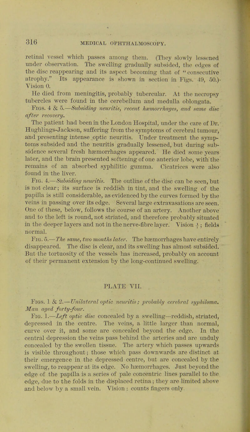 rotimil vessel which passes among them. (They slowly lessened under observation. The swelling gradually subsided, the edges of the disc reappearing and its aspect becoming that of “ consecutive atrophy.” Its appearance is shown in section in Figs. 49, 00.) • Vision 0. He died from meningitis, probably tubercular. At the necropsy tubercles were found in the cerebellum and medulla oblongata. Figs. 4 & 5.—Subsiding neuritis, recent hsemorrhages, and same disc after recovery. The patient had been in the London Hospital, under the care of Dr. Hughlings-Jackson, suffering from the symptoms of cerebral tumom-, and presenting intense optic neiuitis. Under treatment the symp- toms subsided and the neuritis gradually lessened, but diuing sub- sidence several fresh hsemorrhages appeared. He died some years later, and the brain presented softening of one anterior lobe, with the remains of an absorbed syphilitic gumma. Cicatrices were also found in the liver. Fig. 4.—Subsiding neuritis. The outline of the disc can be seen, but is not clear; its surface is reddish in tint, and the swelling of the papilla is still considerable, as evidenced by the curves formed by the veins in passing over its edge. Several large extravasations are seen. One of these, below, follows the course of an artery. Another above and to the left is round, not striated, and therefore probably situated in the deeper layers and not in the nerve-fibre layer. Vision -J; fields normal. Fig. 5.— The same, tivo months later. The hsemorrhages have entirely disappeared. The disc is clear, and its swelling has almost subsided. But the tortuosity of the vessels has increased, probably on account of them permanent extension by the long-continued swelling. PLATE VII. Figs. 1 & 2.— Unilateral optic neuritis; probably cerebral syphiloma. Man aged forty-four. Fig. I.—Left optic disc concealed by a swelling—reddish, striated, depressed in the centre. The veins, a little larger than normal, curve over it, and some are concealed beyond the edge. In the central depression the veins pass behind the arteries and are unduly concealed by the swollen tissue. The artery which passes upwards is visible throughout; those which pass downwards are distinct at their emergence in the depressed centre, but are concealed by the swelling, to reappear at its edge. No hsemorrhages. Just be3mnd the edge of the papilla is a series of pale concentric lines parallel to the edge, due to the folds in the displaced retina; they are limited above and below by a small vein. Vision : counts fingers only.