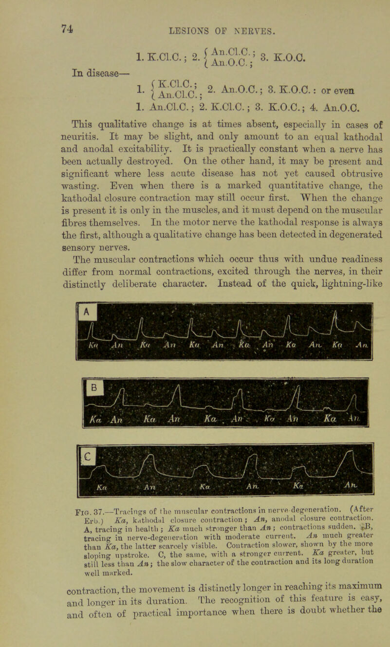 1. K.C1.C.; 2. | 3. K.O.C. In disease— 1. [ ; 2- A 0 0'; 3- E.O.C.: or even 1. An.Cl.C.; 2. K.C1.C.; 3. K.O.C.; 4. An.O.C. Tliis qualitative change is at times absent, especially in cases of neuritis. It may be slight, and only amount to an equal kathodal and anodal excitability. It is practically constant when a nerve has been actually destroyed. On the other hand, it may be present and significant where less acute disease has not yet caused obtrusive wasting. Even when there is a marked quantitative change, the kathodal closure contraction may still occur first. When the change is present it is only in the muscles, and it must depend on the muscular fibres themselves. In the motor nerve the kathodal response is always the first, although a qualitative change has been detected in degenerated sensory nerves. The muscular contractions which occur thus with undue readiness differ from normal contractions, excited through the nerves, in their distinctly deliberate character. Instead of the quick, lightning-like Fig. 37.—Tracings of tlie muscular contractions in nerve degeneration. (After Erb.) Ka, kathodal closure contraction; An, anodal closure contraction. A, tracing in health ; Ka much stronger than An; contractions sudden. j>B, tracing in nerve-degeneration with moderate current. An much greater than Ka, the latter scarcely visible. Contraction slower, shown by the more sloping upstroke. C, the same, with a stronger current. Ka greater, but still less than An; the slow character of the contraction and its long duration well marked. contraction, the movement is distinctly longer in reaching its maximum and longer in its duration. The recognition of this feature is easy, and often of practical importance when there is doubt whether the