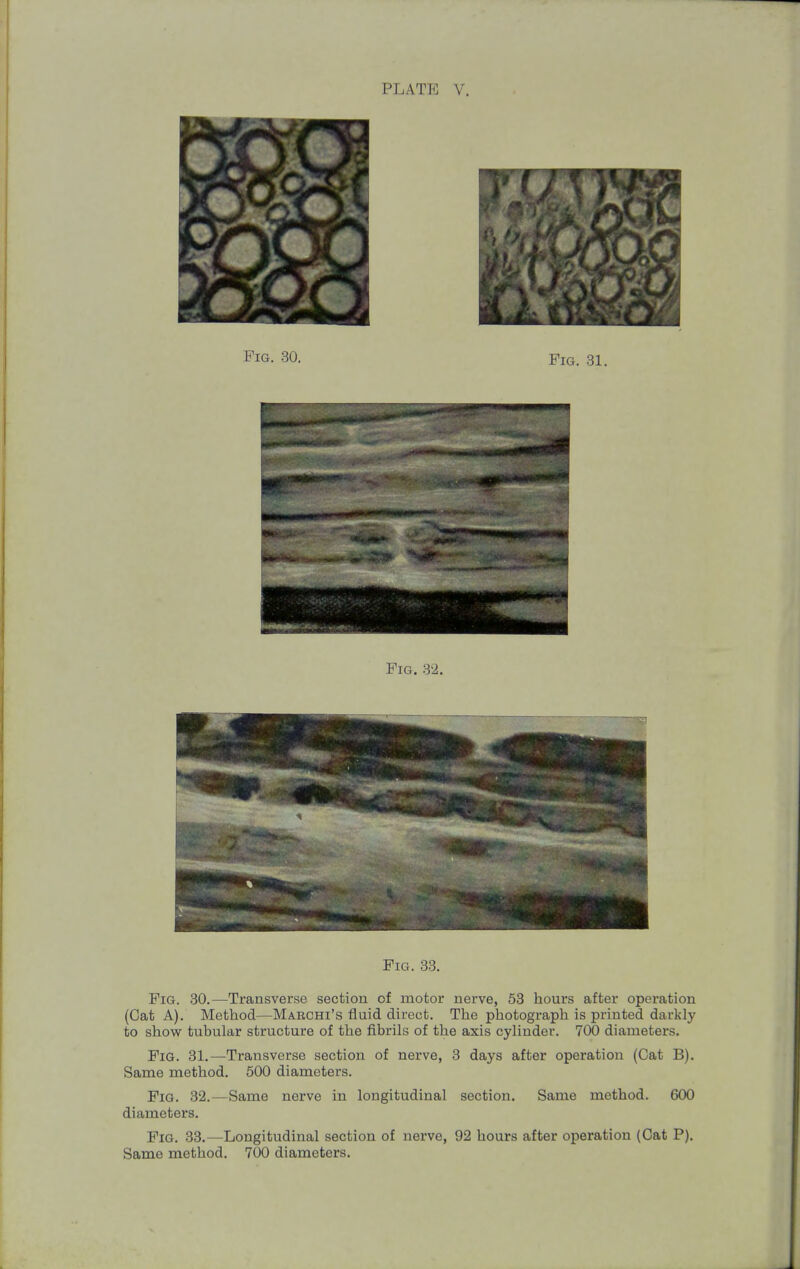 Fig. 30. Fig. 31. ^ • ; ^ - * ***** ■«* F ^^^^ Fig. 32. Fig. 33. Fig. 30.—Transverse section of motor nerve, 53 hours after operation (Cat A). Method—Marchi's fluid direct. The photograph is printed darkly to show tubular structure of the fibrils of the axis cylinder. 700 diameters. Fig. 31.—Transverse section of nerve, 3 days after operation (Cat B). Same method. 500 diameters. Fig. 32.—Same nerve in longitudinal section. Same method. 600 diameters. Fig. 33.—Longitudinal section of nerve, 92 hours after operation (Cat P). Same method. 700 diameters.