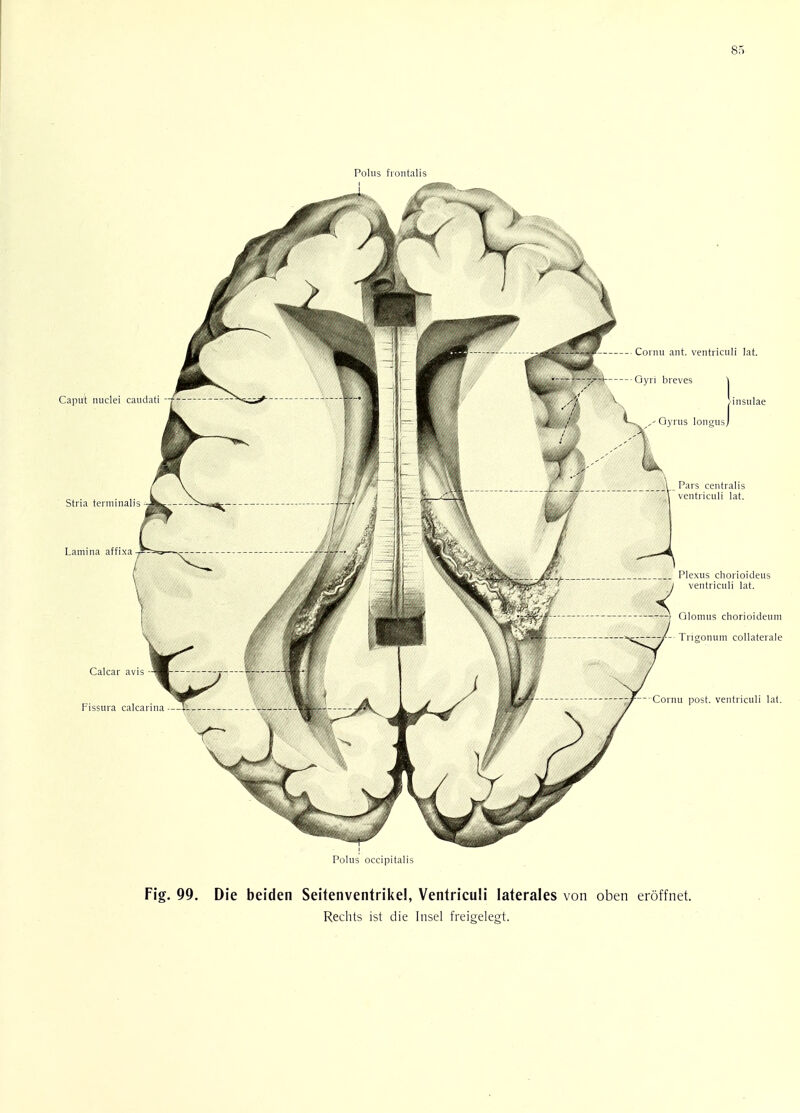 Fig. 99. Die beiden Seitenventrike!, Ventriculi laterales von oben eroffnet. Rechts ist die Insel freigelegt.