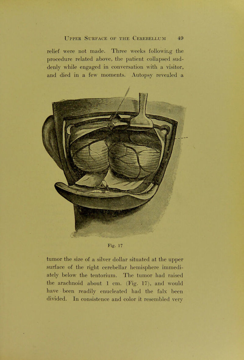 relief were not made. Three weeks following the procedure related above, the patient collapsed sud- denly while engaged in conversation with a visitor, and died in a few moments. Autopsy revealed a Fig. 17 tumor the size of a silver dollar situated at the upper surface of the right cerebellar hemisphere immedi- ately below the tentorium. The tumor had raised the arachnoid about 1 cm. (Fig. 17), and would have been readily enucleated had the falx been divided. In consistence and color it resembled very