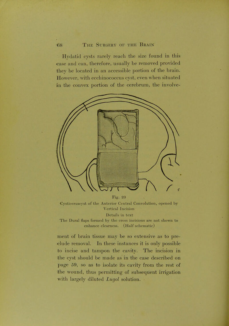 Hydatid cysts rarely reach the size found in this case and can, therefore, usually be removed provided they be located in an accessible portion of the brain. However, with ecchinococcus cyst, even when situated in the convex portion of the cerebrum, the involve- Fig. 20 Cysticeruscyst of the Anterior Central Convolution, opened by Vertical Incision Details in text The Dural flaps formed by the cross incisions are not shown to enhance clearness. (Half schematic) ment of brain tissue may be so extensive as to pre- clude removal. In these instances it is only possible to incise and tampon the cavity. The incision in the cyst should be made as in the case described on page 59, so as to isolate its cavity from the rest of the wound, thus permitting of subsequent irrigation with largely diluted Lucjol solution.