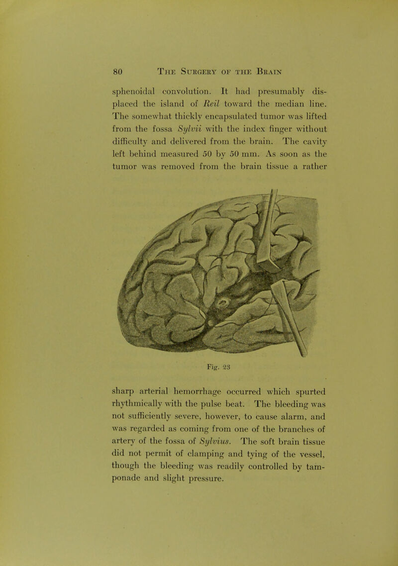 sphenoidal convolution. It had presumably dis- placed the island of Reil toward the median line. The somewhat thickly encapsulated tumor was lifted from the fossa Sylvii with the index finger without difficulty and delivered from the brain. The cavity left behind measured 50 by 50 mm. As soon as the tumor was removed from the brain tissue a rather | Fig. 23 sharp arterial hemorrhage occurred which spurted rhythmically with the pulse beat. The bleeding was not sufficiently severe, however, to cause alarm, and was regarded as coming from one of the branches of artery of the fossa of Sylvius. The soft brain tissue did not permit of clamping and tying of the vessel, though the bleeding was readily controlled by tam- ponade and slight pressure.