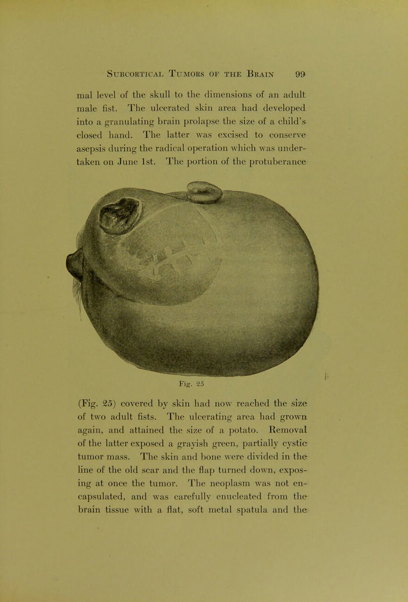 mal level of the skull to the dimensions of an adult male fist. The ulcerated skin area had developed into a granulating brain prolapse the size of a child's closed hand. The latter was excised to conserve asepsis during the radical operation which was under- taken on June 1st. The portion of the protuberance Fig. 25 (Fig. 25) covered by skin had now reached the size of two adult fists. The ulcerating area had grown again, and attained the size of a potato. Removal of the latter exposed a grayish green, partially cystic tumor mass. The skin and bone were divided in the line of the old scar and the flap turned down, expos- ing at once the tumor. The neoplasm was not en- capsulated, and was carefully enucleated from the brain tissue with a flat, soft metal spatula and the