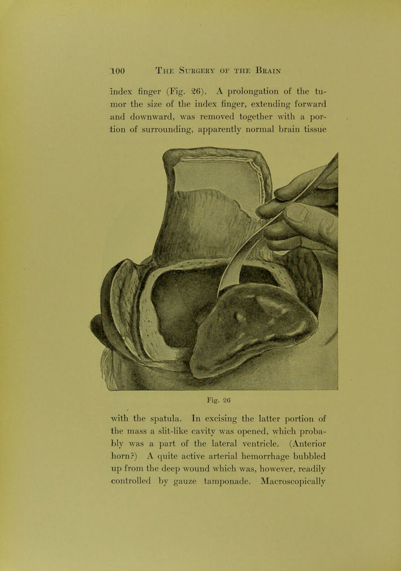 Index finger (Fig. 26). A prolongation of the tu- mor the size of the index finger, extending forward and downward, was removed together with a por- tion of surrounding, apparently normal brain tissue Fig. 26 with the spatula. In excising the latter portion of the mass a slit-like cavity was opened, which proba- bly was a part of the lateral ventricle. (Anterior liorn?) A quite active arterial hemorrhage bubbled up from the deep wound which was, however, readily controlled by gauze tamponade. Macroscopic;! 11 v