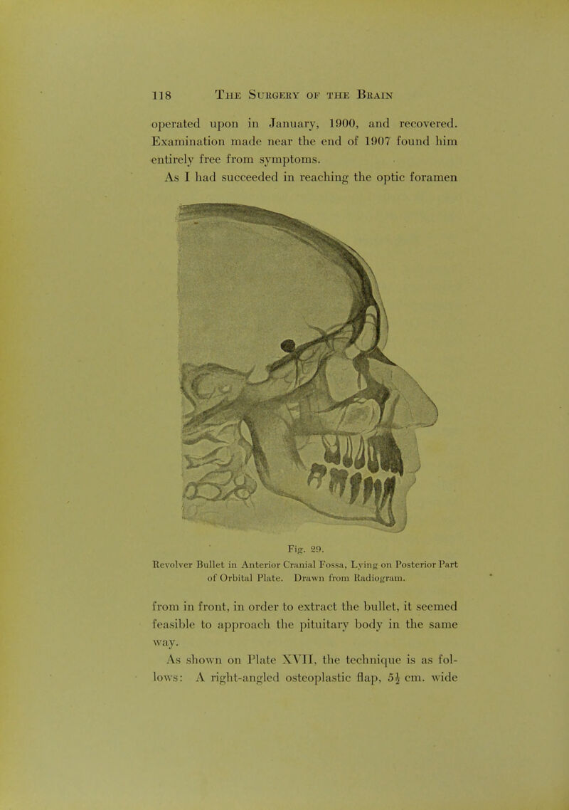 operated upon in January, 1900, and recovered. Examination made near the end of 1907 found him entirely free from symptoms. As I had succeeded in reaching the optic foramen Fig. 29. Revolver Bullet in Anterior Cranial Fossa, Lying on Posterior Part of Orbital Plate. Draw n from Radiogram. from in front, in order to extract the bullet, it seemed feasible to approach the pituitary body in the same way. As shown on Plate XVII. the technique is as fol- lows: A right-angled osteoplastic flap, 5\ cm. wide
