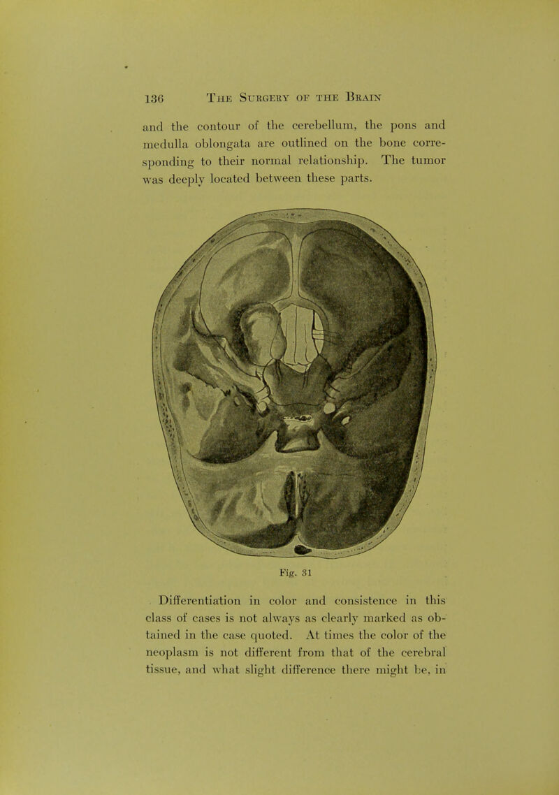 and the contour of the cerebellum, the pons and medulla oblongata are outlined on the bone corre- sponding to their normal relationship. The tumor was deeply located between these parts. Fig. 31 Differentiation in color and consistence in this class of cases is not always as clearly marked as ob- tained in the case quoted. At times the color of the neoplasm is not different from that of the cerebral tissue, and what slight difference there might be, in