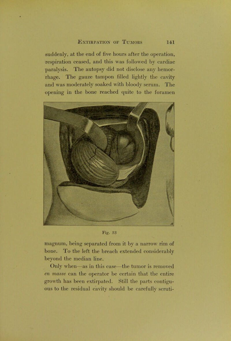 suddenly, at the end of five hours after the operation, respiration ceased, and this was followed by cardiac paralysis. The autopsy did not disclose any hemor- rhage. The gauze tampon filled lightly the cavity and was moderately soaked with bloody serum. The opening in the bone reached quite to the foramen Fig. 33 magnum, being separated from it by a narrow rim of bone. To the left the breach extended considerably beyond the median line. Only when—as in this case—the tumor is removed en masse can the operator be certain that the entire growth has been extirpated. Still the parts contigu- ous to the residual cavity should be carefully scruti-