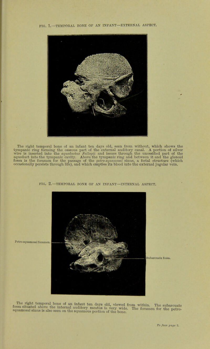 ylfi> 1.—TEMPORAL BONE OF AN INFANT—EXTERNAL ASPECT. The right temporal bone of an infant ten days old, seen from without, which shows the tympanic ring forming the osseous part of the external auditory canal. A portion of silver wire is inserted into the aqueductus Fallopii and issues through the unossified part of the aqueduct into the tympanic cavity. Above the tympanic ring and between it and the glenoid fossa is the foramen for the passage of the petro-squamosal sinus, a fcetal structure (which occasionally persists through life), and which empties its blood into the external jugular vein. FIG. 2.—TEMPORAL BONE OF AN INFANT—INTERNAL ASPECT. Petro-squamosal fotamen. Subarcuate fossa. The right temporal bono of an infant ten days old, viowed from within. The subarcuate fossa situated above the internal auditory meatus ifl very wide. The fo men for the netro squamosal sinus is also seen on the squamous portion of the bono Xiamen lor tne petio-