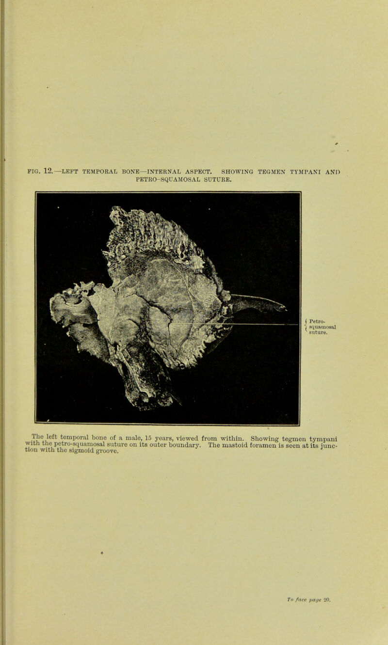 FIG. 12.—LEFT TEMPORAL BONE—INTERNAL ASPECT. SHOWING TEGMEN TYMPANI AND PETRO-SQUAMOSAL SUTURE. •Twi!eft temPoral Done of a male, 15 years, viewed from within. Showing tegmen tympani with the petro-squamosal suture on its outer boundary. The mastoid foramen is seen at its junc- tion with the sigmoid groove. To fun- paga '20.