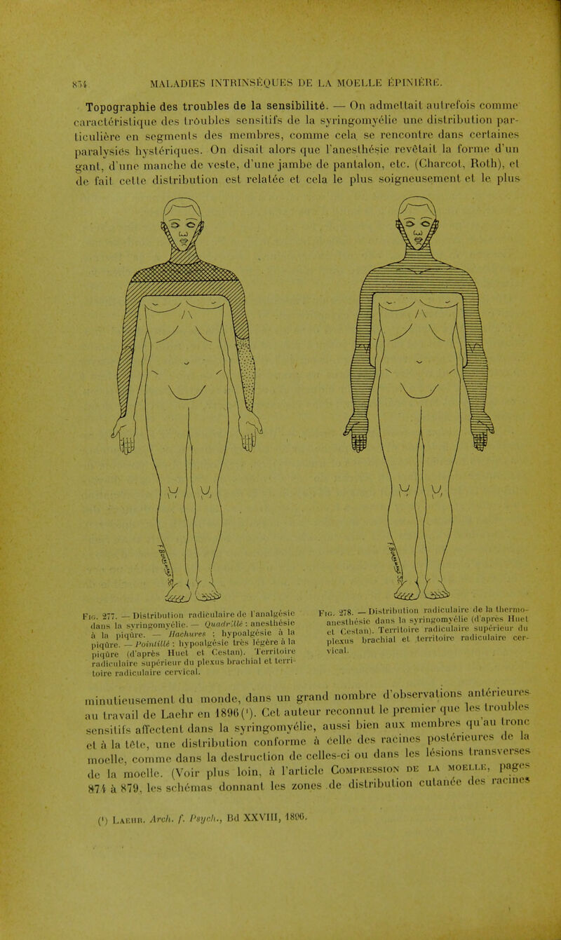 Topographie des troubles de la sensibility. — On admcllaiL aulrefois commc caracLet-islique des IrOubles sciisilil's de la syringomyelie une dislribulion par- ticuliere en segmenls des membres, comme cela. se rencontre dans cerlaines paralysies hyst^riques. On disait alors que Taneslh^sie rcv6lail la forme d'un ganl, d'une manche de vesle, d'une jambe de panlalon, etc. (Charcot, Roth), et de fait cette distribution est relat6e et cela le plus soigneusement et le plus Fk;. 277. — Dislribulion radiculaire fie I'analgosie dans la svringomyelic. — QuadrUlii: aneslliesie a la piqire. — 'jlachures ; iiypoalgesie a la piqQre. — Poinlille : hypoaifiesie Ires It'Kfere a la l)iqure (d'aprfes Huet et Ceslan). Tcrriloirc radiculaire superieur du ple.^us brachial el terri- loire radiculaire cervical. Fig TiS. — Dislribulion radiculaire de la llicrmo- anesUiesic dans la syringomyelie (d'apres Huel el Ceslan). Terriloire radiculaire superieur du plexus brachial el terriloire radiculaire cer- vical. minulieusement du monde, dans un grand nombre d'observations anlerieures au travail de Laehr en 1890('). Get auleur reconnut le premier que les troubles scnsitifs an'ectent dans la syringomy6lie, aussi bien aux membres qu au tronc ct h la t6le, une distribution conformc a (ielle des racines poster.eures de la moelle, comme dans la destruclion de celles-ci ou dans Ics les.ons transverse^ de la moelle. (Voir plus loin, a I'article Comphession de la moeim:, pages 874 k H79, les sr hemas donnant les zones de distribution cutan6c des racincs (') Laehk. Arch. f. Psrjch., Bd XXVIII, 1800.