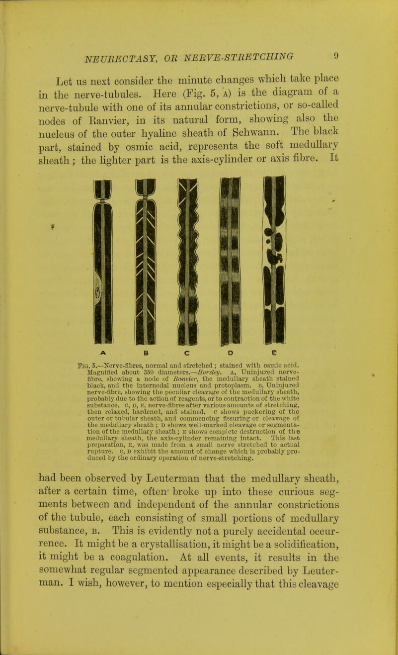 Let us next consider the minute changes which take place in the nerve-tubules. Here (Fig. 5, a) is the diagram of a nerve-tubule with one of its annular constrictions, or so-called nodes of Ranvier, in its natural form, showing also the nucleus of the outer hyaline sheath of Schwann. The black part, stained by osmic acid, represents the soft medullary sheath ; the lighter part is the axis-cylinder or axis fibre. It A B C D E Fig. 5.—Nerve-fibres, normal and stretched ; stained with osmic acid. Magnified about 350 diameters.—Horsley. A, Uninjured nerve- fibre, showing a node of Ranvier, the medullary sheath stained black, and the internodal nucleus and protoplasm, b, Uninjured nerve-fibre, showing the peculiar cleavage of the medullary sheath, probably due to the action of reagents, or to contraction of the white substance, c, d, e, nerve-fibres after various amounts of stretching, then relaxed, hardened, and stained, c shows puckering of the outer or tubular sheath, and commencing Assuring or cleavage of the medullary sheath ; D shows well-marked cleavage or segmenta- tion of the medullary sheath; e shows complete destruction of the medullary sheath, the axis-cylinder remaining intact. This last preparation, e, was made from a small nerve stretched to actual rupture, c, D exhibit the amount of change which is probably pro- duced by the ordinary operation of nerve-stretching. had been observed by Leuterman that the medullary sheath, after a certain time, often broke up into these curious seg- ments between and independent of the annular constrictions of the tubule, each consisting of small portions of medullary substance, b. This is evidently not a purely accidental occur- rence. It might be a crystallisation, it might be a solidification, it might be a coagulation. At all events, it results in the somewhat regular segmented appearance described by Leuter- man. I wish, however, to mention especially that this cleavage