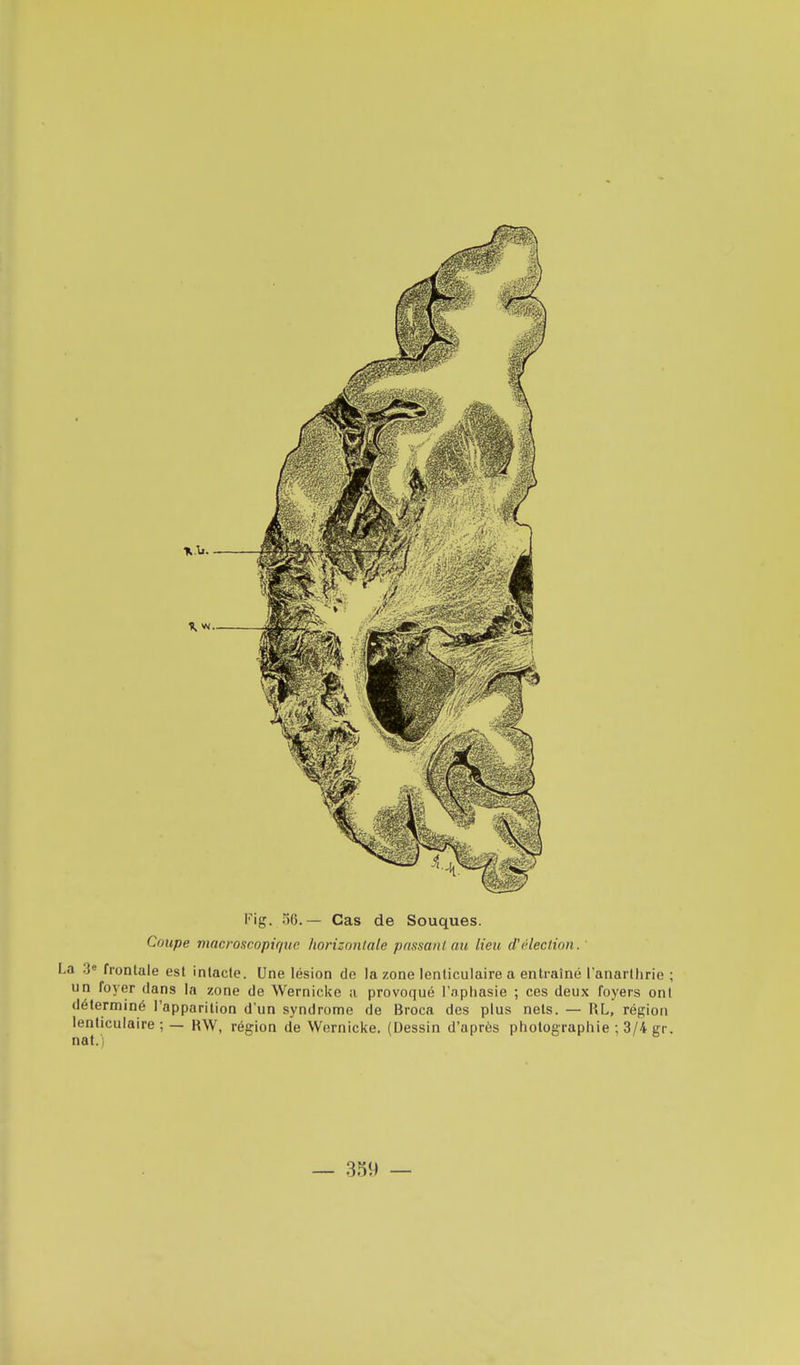 Fig. 56.— Cas de Souques. Coupe macroscopique horizontale passant au lieu d'élection.' 1 3e frontale est intacte. Une lésion de la zone lenticulaire a entraîné l'anarthrie ; un foyer dans la zone de Wernicke ;i provoqué l'aphasie ; ces deux foyers ont déterminé l'apparition d'un syndrome de Broca des plus nets. — RL, région lenticulaire; — R\V, région de Wernicke. (Dessin d'après photographie ; 3/4 gr. nat.)