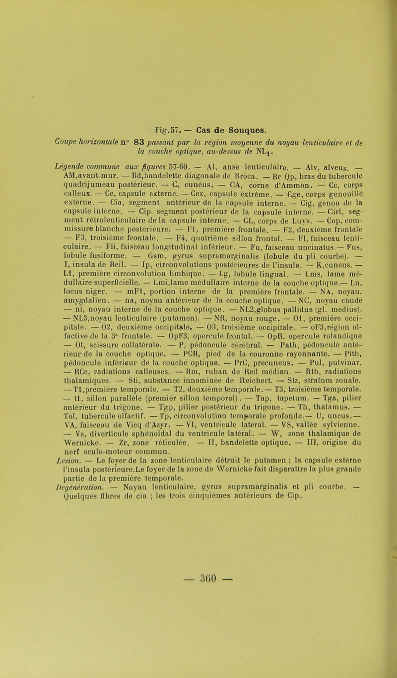 Coupe horizontale n° 83 passant par la région moyenne du noyau lenticulaire et de la couche optique, au-dessus de NLj. Légende commune aux figures 57-60. — Al, anse lenticulaire. — Alv, alveus. — AM,avant-mur. — Bd,bandelette diagonale de Broca. — Br Qp, bras du tubercule quadrijumeau postérieur. — G, cunéus. — CA, corne d'Ammon. — Ce, corps calleux. — Ce, capsule externe. —Cex, capsule extrême. — Cge, corps genouillé externe. — Cia, segment antérieur de la capsule interne. — Cig, genou de la capsule interne. — Cip. segment postérieur de la capsule interne. — Cirl, seg- ment rétrolenticulaire de la capsule interne. — CL, corps de Luys. — Cop, com- missure blanche postérieure. — Fl, première frontale. — F2, deuxième frontale — F3, troisième frontale. — F4, quatrième sillon frontal. — Fl, faisceau lenti- culaire. — Fli, faisceau longitudinal inférieur. — Fu, faisceau uncinatus.— Fus, lobule fusiforme. — Gsm, gyrus supramarginalis (lobule du pli courbe). — I, insulade Beil. — Ip, circonvolutions postérieures de l'insula. — R,cuneus. — Ll, première circonvolution limbique. — Lg, lobule lingual. — Lms, lame mé- dullaire superficielle. — Lmi,lame médullaire interne de la couche optique.— Ln, locus niger. — mFl, portion interne de la première frontale. — Na, noyau, amygdalien. — na, noyau antérieur de la couche optique. —NC, noyau caudé — ni, noyau interne de la couche optique. — NL2,globus pallidus (gl. médius). — NL3,noyau lenticulaire (putamen). —NB, noyau rouge. — 01, première occi- pitale. — 02, deuxième occipitale. — 03, troisième occipitale. — oF3,région ol- factive de la 3e frontale. — 0pF3, opercule frontal. — OpB, opercule rolandique — Ot, scissure collatérale. — P, pédoncule cérébral. — Path, pédoncule anté- rieur de la couche optique. — PCB, pied de la couronne rayonnante. — Pith, pédoncule inférieur de la couche optique. — PrC, precuneus. — Pul. pulvinar. — BCc, radiations calleuses. —Bm, ruban de Beil médian. — Bth, radiations thalamiques. — Sti, substance innominée de Reichert. — Stz, stratum zonale. — Tl,première temporale. — T2, deuxième temporale.— T3, troisième temporale. — tl, sillon parallèle (premier sillon temporal). — Tap, tapetum. — Tga, pilier antérieur du trigone. — Tgp, pilier postérieur du trigone. — Th, thalamus. — Toi, tubercule olfactif. —Tp, circonvolution temporale profonde.— U, uncus.— VA, faisceau de Vicq d'Azyr. —VI, ventricule latéral. — VS, vallée sylvienne. — Vs, diverticule sphénoïdal du ventricule latéral. — W, zone thalamique de Wernicke. — Zr, zone réticulée. — II, bandelette optique. — III, origine du nerf oculo-moleur commun. Lésion. — Le foyer de la zone lenticulaire détruit le putamen ; la capsule externe l'insula postérieure.Le foyer de la zone de Wernicke fait disparaître la plus grande partie de la première temporale. Degénéralion. — Noyau lenticulaire, gyrus supramarginalis et pli courbe. — Quelques fibres de cia ; les trois cinquièmes antérieurs de Cip.