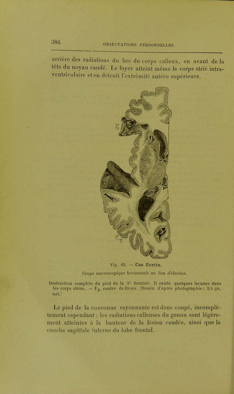 OBSEIIVATIONS PERSONxNELLES arrière des radiations du bec du corps calleux, en avant de la tête du noyau caudé. Le foyer atteint même le corps strié intra- ventriculaire et en détruit l'extrémité antéro-supérieure. Fig. G5. — Cas Bertin. Coupe macroscopique horizontale au lieu d'élection. Destruction complète du pied de la 3° frontale. Il existe quelques lacunes dans les corps striés. — F3, centre de limca. (Dessin d'après photographie ; 3/4 gr. nat.) Le pied de la couronne rayonnante est donc coupé, incomplè- tement cependant; les radiations calleuses du genou sont légère- ment atteintes ù la hauteur de la lésion caudée, ainsi que la couche sagittale interne du lobe frontal.