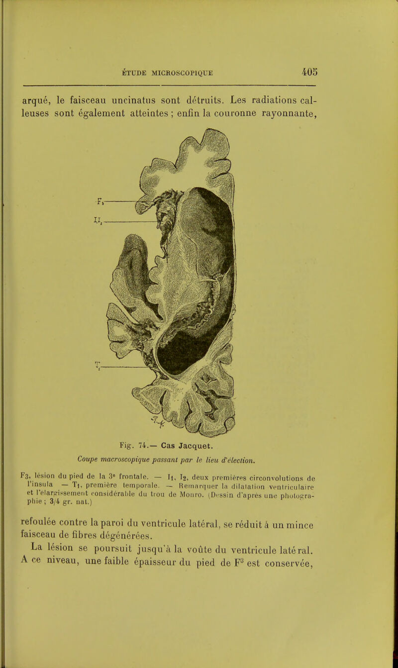 arqué, le faisceau uncinatus sont détruits. Les radiations cal- leuses sont également atteintes ; enfin la couronne rayonnante, Fig. 74.— Cas Jacquet. Coupe macroscopique passant par le lieu d'élection. F3, lésion du pied de la 3» frontale. — Ii, I2, deux premièrps circonvolutions de i'insula — Ti. première temporale. — Remarquer la dilalalion veniriculaire et l'elarp-issemerit considérable du trou de Moiiro. (Dfssin d'après une phulora- phie ; 3/4 gr. ual.) refoulée contre la paroi du ventricule latéral, se réduit à un mince faisceau de fibres dégénérées. La lésion se poursuit jusqu'à la voûte du ventricule latéral. A ce niveau, une faible épaisseur du pied de est conservée.