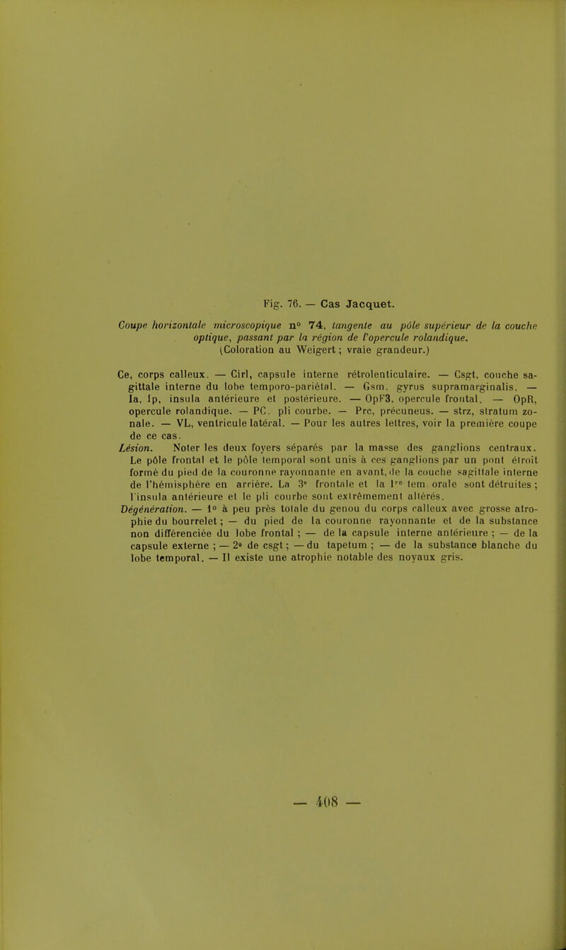 Coupe horizontale microscopique n° 74, tangente au pôle supérieur de la couche optique, passant par la région de l'opercule rolandique. (Coloration au Weigert ; vraie grandeur.) Ce, corps calleux. — Cirl, capsule interne rétrolenliculaire. — Csgt, couche sa- gittale interne du lobe temporo-pariélal. — Gsm. gyrus supramarginalis. — la, Ip, insula antérieure et postérieure. — OpF3, opercule frontal. — OpR, opercule rolandique. — PC. pli courbe. — Prc, précuneus. — strz, siratum zo- nale. — VL, ventricule latéral. — Pour les autres lettres, voir la première coupe de ce cas. Lésion. Noter les deux foyers séparés par la masse des ganglions centraux. Le pôle frontal et le pôle temporal sont unis à ces ganglions par un pont éirnil formé du pied de la couronne rayonnanie en avant, de la couche sagittale interne de l'hémisphère en arrière. La 3° frontale et la i^ tem orale sont détruites ; l'insiila antérieure et le pli courbe sont extrêmement altérés. Dégénération. — 1 à peu près totale du genou du corps calleux avec grosse atro- phie du bourrelet ; — du pied de la couronne rayonnante et de la substance non différenciée du lobe frontal ; — de la capsule interne antérieure ; — de la capsule externe ; — 2<> de csgt ; — du tapetum ; — de la substance blanche du lobe temporal. — Il existe une atrophie notable des noyaux gris.