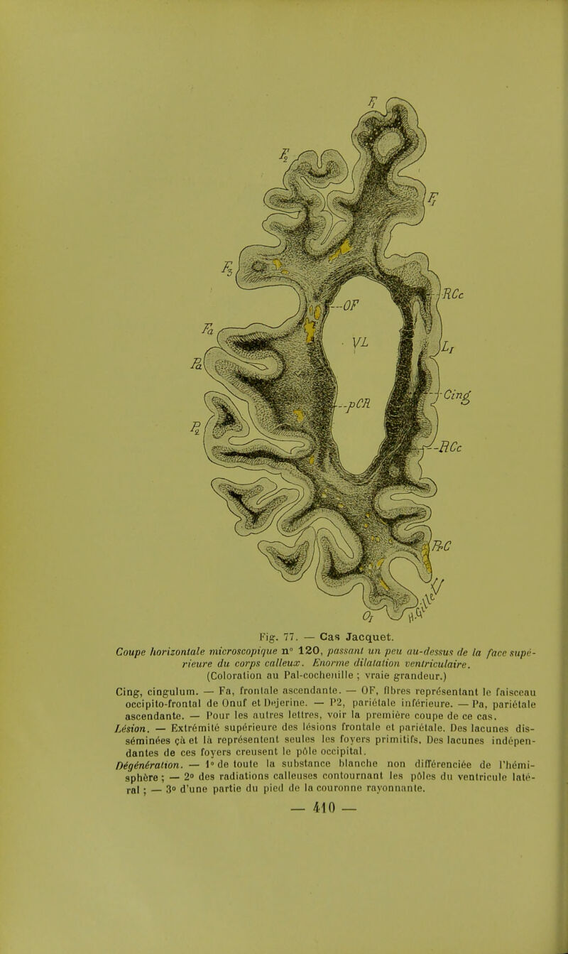 Fig. 77. — Cas Jacquet. Coupe horizontale microscopigue n 120, passant un peu au-dessus de la face supé- rieure du corps calleux. Enorme dilatation ventriculaire. (Coloration au Pal-cocheiiille ; vraie grandeur.) Cing, cingulum. — Fa, frontale ascendante. — OF, fibres représentant le faisceau occipito-frontal de Onuf et DHjerine. — P2, pariétale inférieure. — Pa, pariétale ascendante. — Pour les autres lettres, voir la première coupe de ce cas. Lésion. — Extrémité supérieure des lésions frontale et pariétale. Des lacunes dis- séminées çà et là représentent seules les foyers primitifs. Des lacunes indépen- dantes de ces foyers creusent le pôle occipital. Hégénération. — 1° de toute la substance blancbe non différenciée de l'Iiémi- sphère ; — 2 des radiations calleuses contournant les pôles du ventricule laté- ral j — 30 d'une partie du pied de la couronne rayonnante.