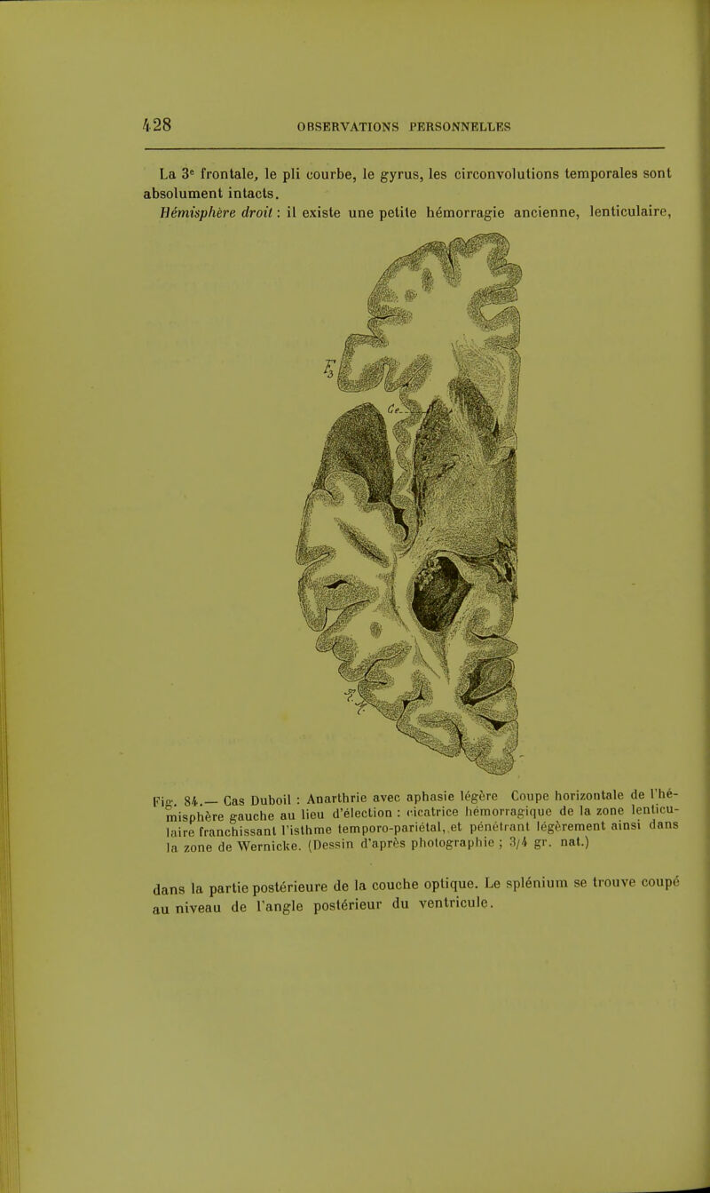 La 3= frontale, le pli courbe, le gyrus, les circonvolutions temporales sont absolument intacts. Hémisphère droit : il existe une petite hémorragie ancienne, lenticulaire, Fie-, 84.— Cas Duboil : Anarthrie avec aphasie légère Coupe horizontale de l'hé- misphère gauche au lieu d'élection : cicatrice hémorragique de la zone lenticu- laire franchissant l'isthme temporo-pariétal,,et pénétrant légèrement ainsi dans la zone de 'Wernicke. (Dessin d'après photographie ; 3/4 gr. nat.) dans la partie postérieure de la couche optique. Le splénium se trouve coupé au niveau de l'angle postérieur du ventricule.