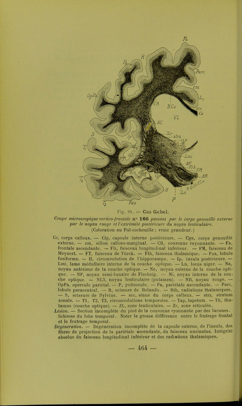 Coupe microscopique verlico-fronlale 166 passant par le corps genouillé externe par le noyau rouge et l'extrémité postérieure du noijau lenticulaire. (Coloration au Pal-cochenille; vraie grandeur.) Ce, corps calleux. — Cip, capsule interne postérieure. — Cge, corps genouillé externe. — cm, sillon calloso-marginal. — CR, couronne rayonnante. — Fa, frontale ascendante. — Fli, faisceau longitudinal inférieur. — FM, faisceau de Mej'nert. — FT, faisceau de Tùrck. — Fth, faisceau thalamique. — Fus, lobule fusiforme. — II, circonvolution de l'hippocampe. — Ip, Insula postérieure. — Lmi, lame médullaire interne de la couche optique. — Ln, locus niger. — Na, noyau antérieur de la couche optique. — Ne, noyau externe de la couche opti- que. — NF, noyau semi-lunaire de Flechsig. — Ni, noyau interne de la cou- che optique. — NL3, noyau lenticulaire (pulamen). — NH, noyau rouge. — OpPa, opercule pariétal.— P, pédoncule. —Pa, pariétale ascendante. — Parc, lobule paracenlral. — R, scissure de Rolando. — Rth, radiations thalamiques. — S, scissure de Sylvius. — sec, sinus du corps calleux. — strz, stratum zonale. — Tl, T2, T3, circonvolutions temporales. —Tap, tapetum. — Th, tha- lamus (couche optique). — ZL, zone lenticulaire. — Zi-, zone réticulée. Lésion. — Section incomplète du pied de la couronne ryonnante par des lacunes. Sclérose du lobe temporal. Noter la grosse difITérence entre le feutrage frontal et le feutrage temporal. Dégénéralion. — Dégénération incomplète de la capsule externe, de l'insula, des fibres de projection de la pariétale ascendante, du faisceau uncinatus. Intégrité absolue du faisceau longitudinal inférieur et des radiations thalamiques.