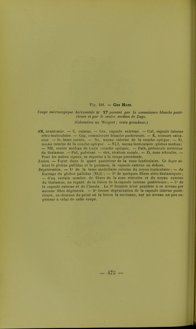 Coupe microscopique horizontale n 17 passant par la commissure blanche posté- rieure et par le centre médian de Luys. (Coloration au Weigert ; vraie grandeur.) AM, avant-mur. — C, cuneus. — Cex, capsule extrême. — Cirl, capsule interne rétro-lenticulaire. — Cop, commissure blanche postérieure. — K, scissure calca- rine — le, lame cornée. — Ne, noyau externe de la couche optique. — Ni, no^au interne de la couche optique. — NL2, noyau lenticulaire (globus médius) — NM, centre médian de Luys ^couche optique). — Path, pédoncule antérieur du thalamus. —Pul, pulvinar. — strz, stratum zonale. — Zr, zone réticulée. — Pour les autres signes, se reporter à la coupe précédente. Lésion. — Foyer dans le quart postérieur de la zone lenticulaire. Ce foyer at- teint le globus pallidus et le pulamen, la capsule externe en dehors. Dégénération. — 1° de la lame médullaire externe du noyau lenticulaire ; — du feutrage du globus pallidus (NL2) ; — 2° de quelques fibres strio-thalamiques ; — d'un certain nombre de fibres de la zone réticulée et du noyau externe du thalamus, en regard de la lésion de la capsule interne postérieure ; — 3° de la capsule externe et de l'insula. La .3^ frontale n'est pénétrée à ce niveau par aucune fibre dégénérée. — 4» Grosse dégénération de la capsule interne posté- rieure, au-dessous du point où la lésion la sectionne, sur un niveau un peu su- périeur à celui de cette coupe.